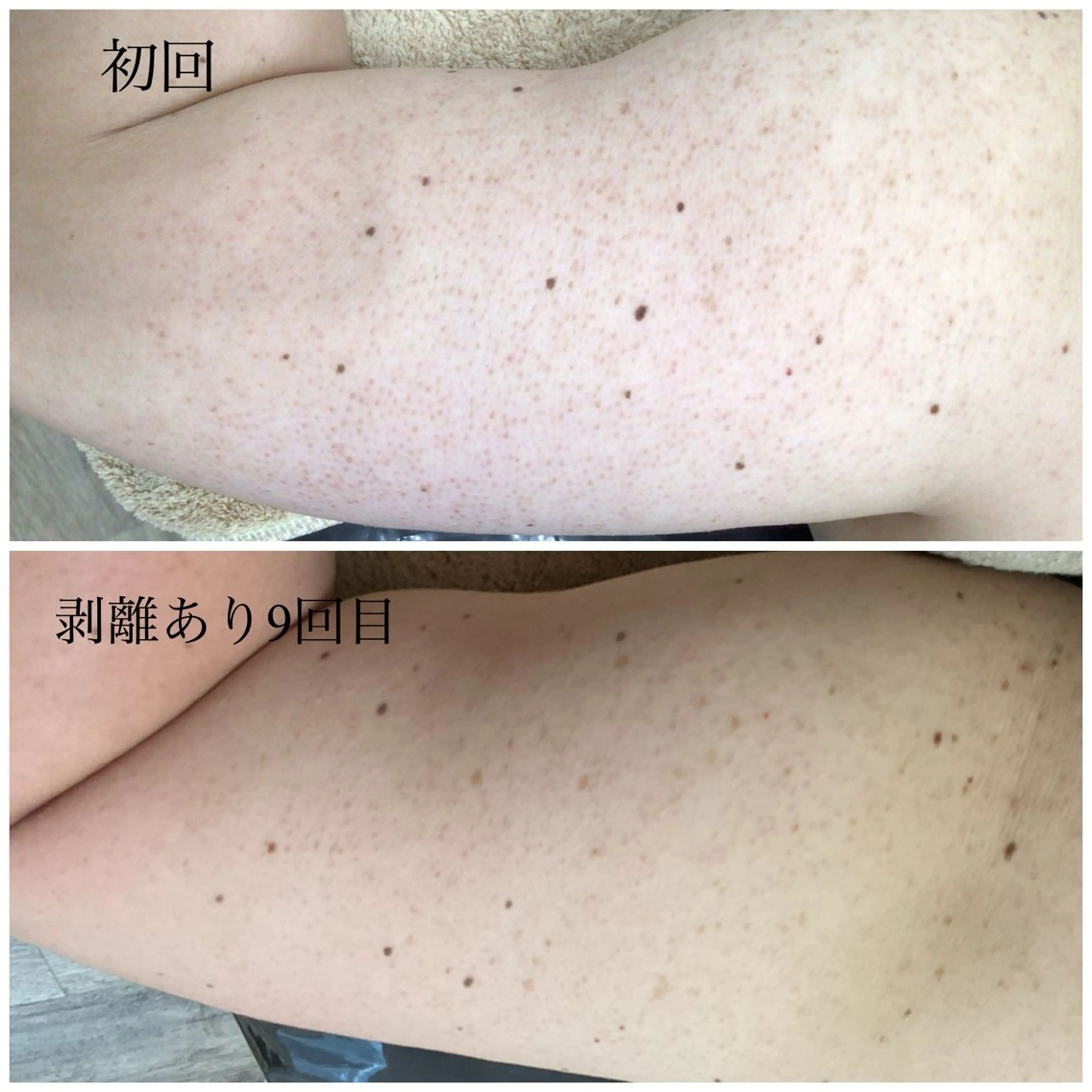 【二の腕ハーブピーリング】ぶつぶつにアプローチ★剥離あり・なし選択可※Google口コミ必須の写真