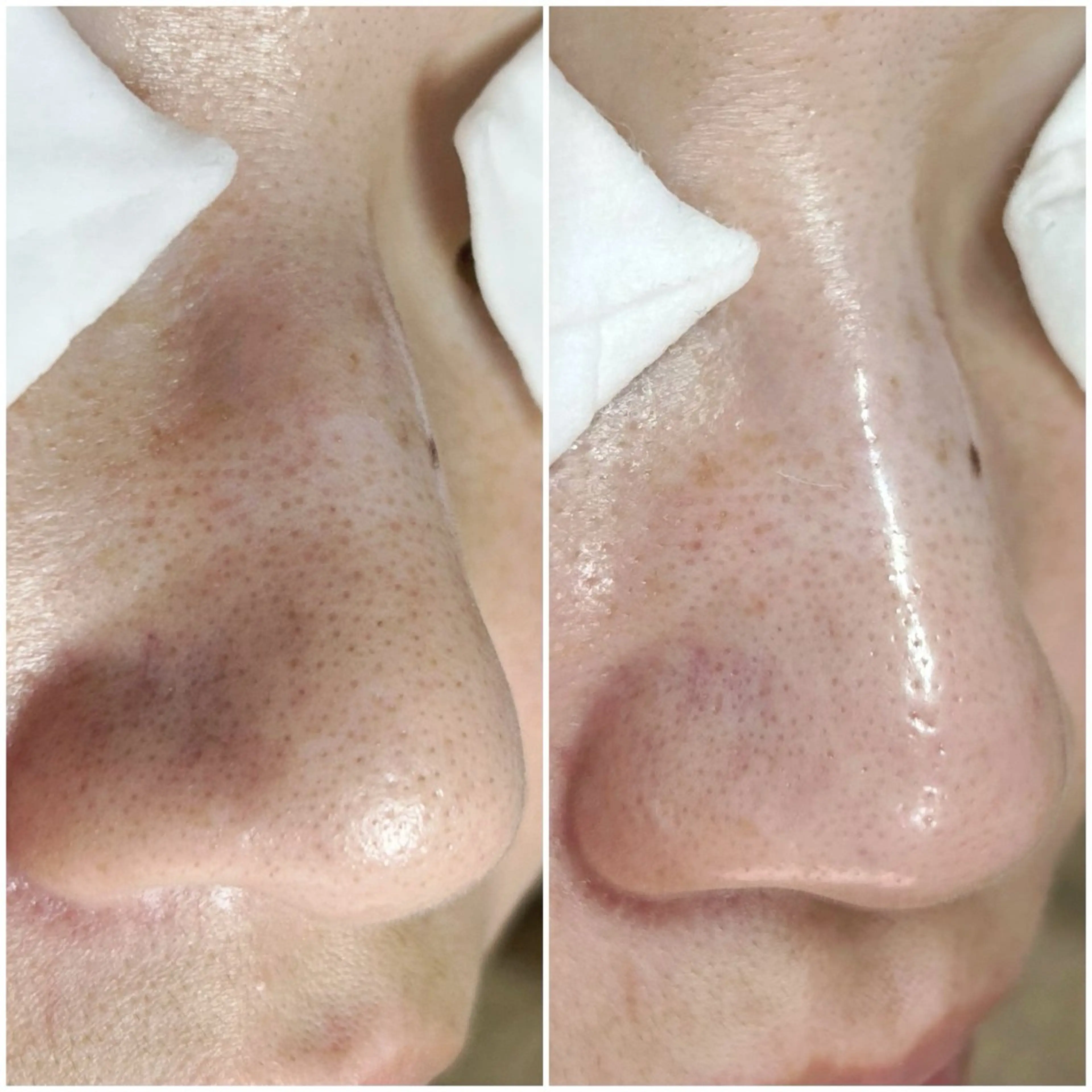 【毛穴洗浄コース】毛穴の悩み改善の写真