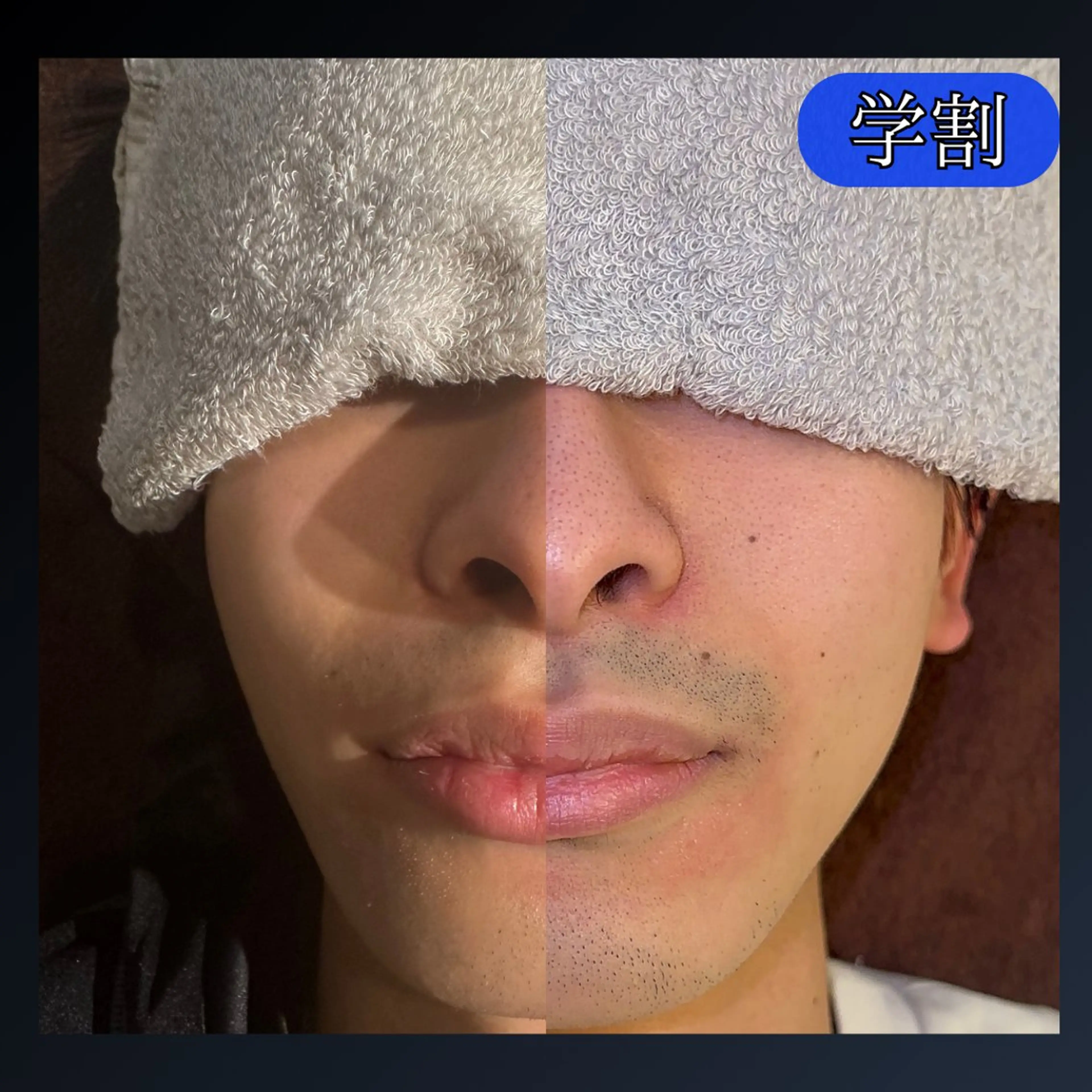 【ミニモ学割】毎月3名様限定                              お財布とお肌に優しいヒゲ脱毛の写真