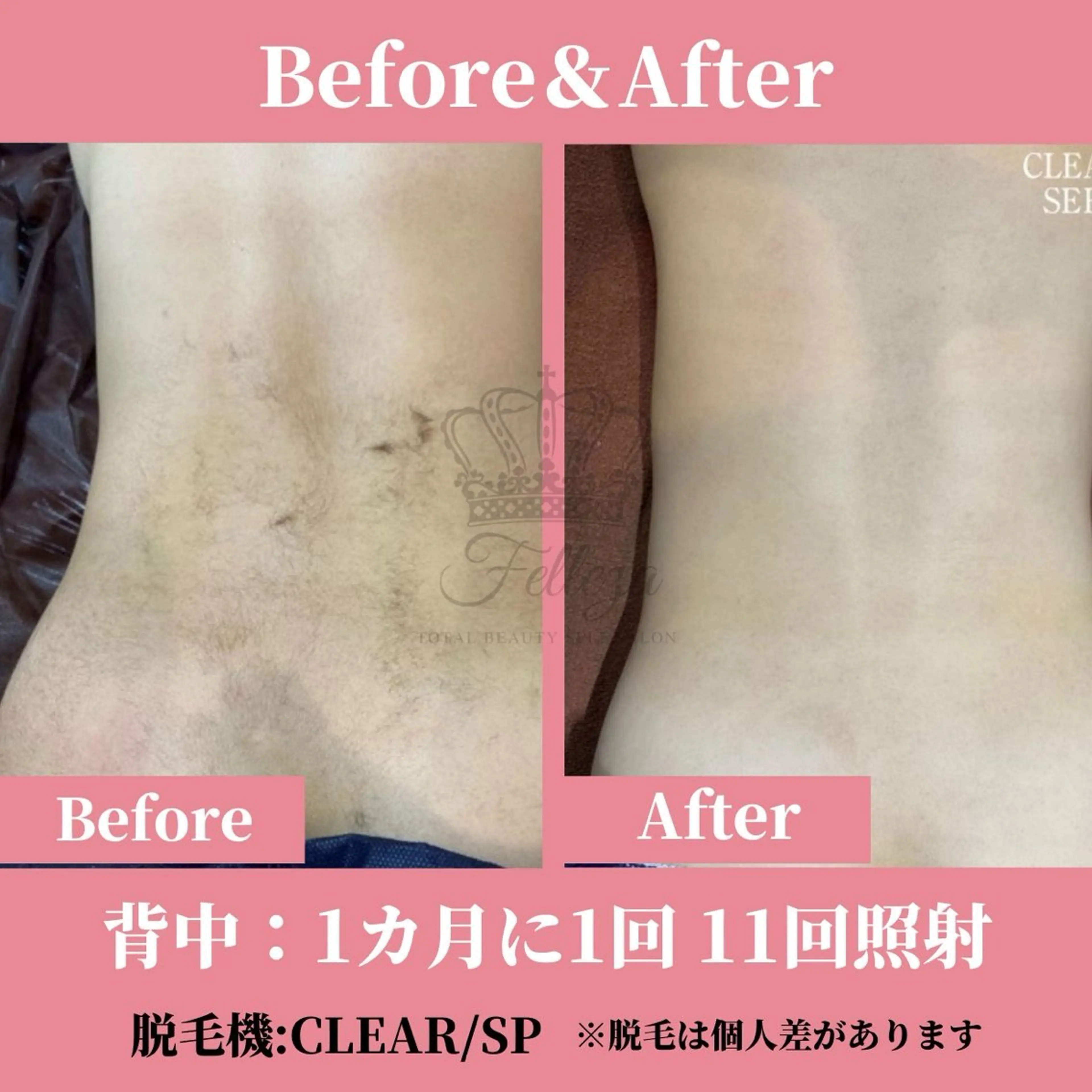 【女性限定/スタッフ施術】お顔/VIO/全身脱毛☆極上美肌脱毛コースの写真