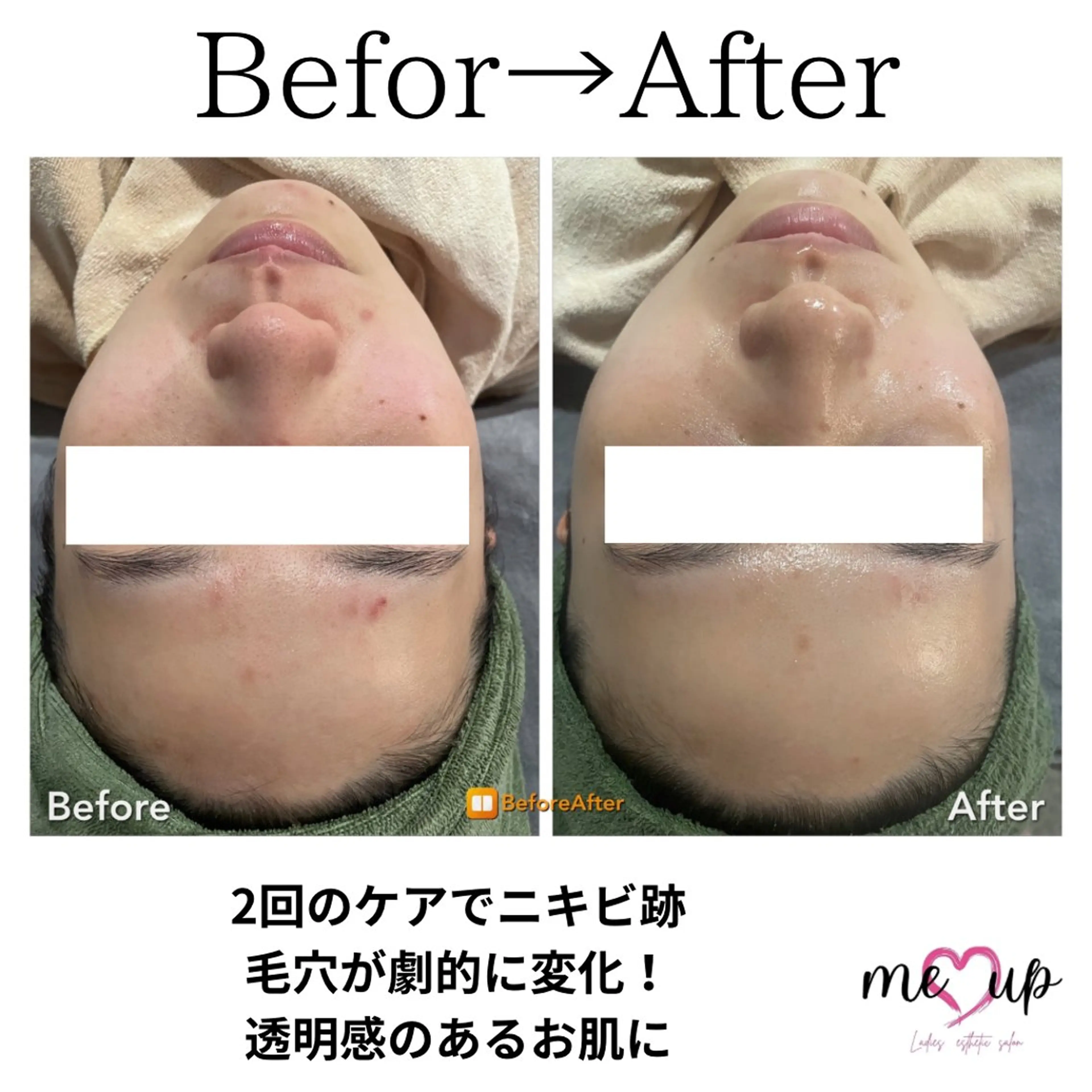 エステ Meupニキビ専門店 背中/ハーブ/ララのその他イメージ