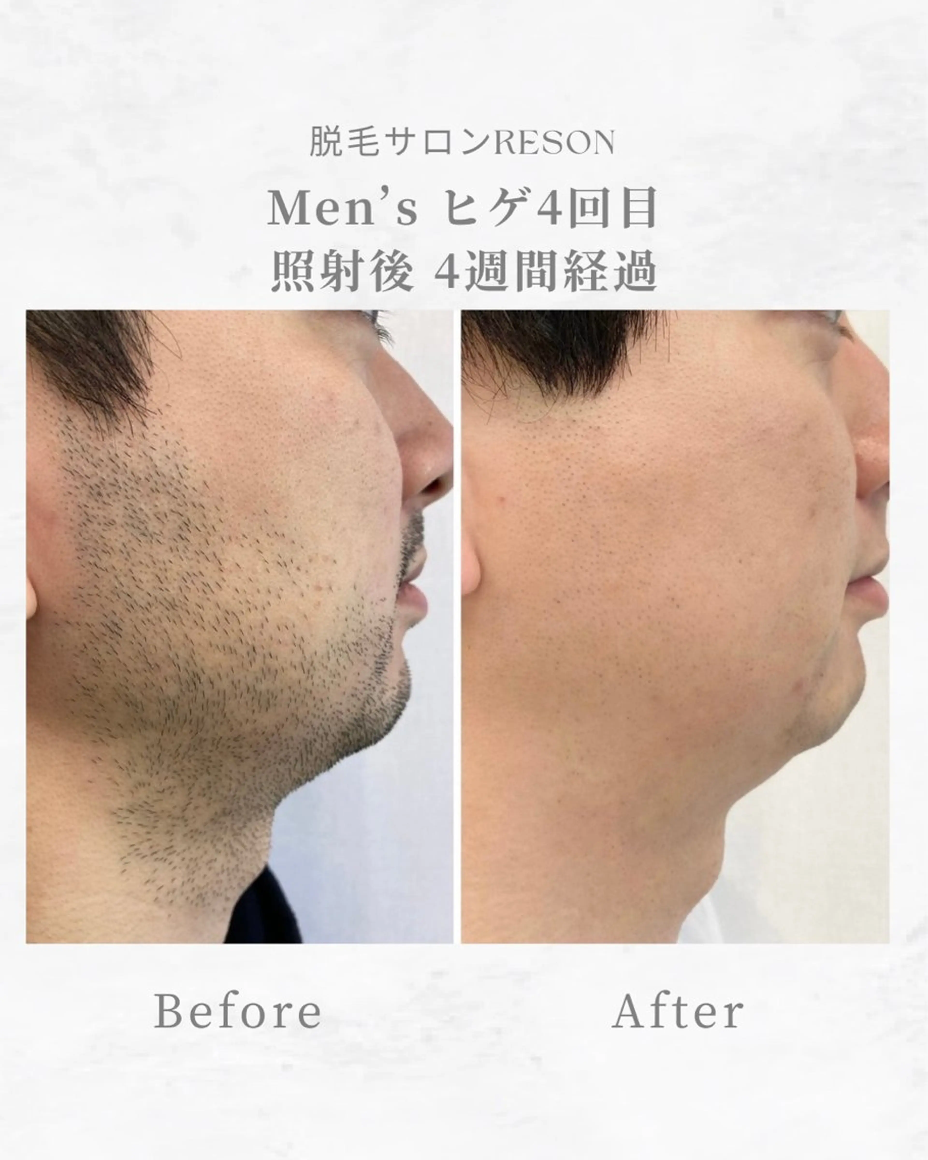 メンズ エステ RESON 調布店所属・都度払いの脱毛サロン RESONのエステ・リラクイメージ