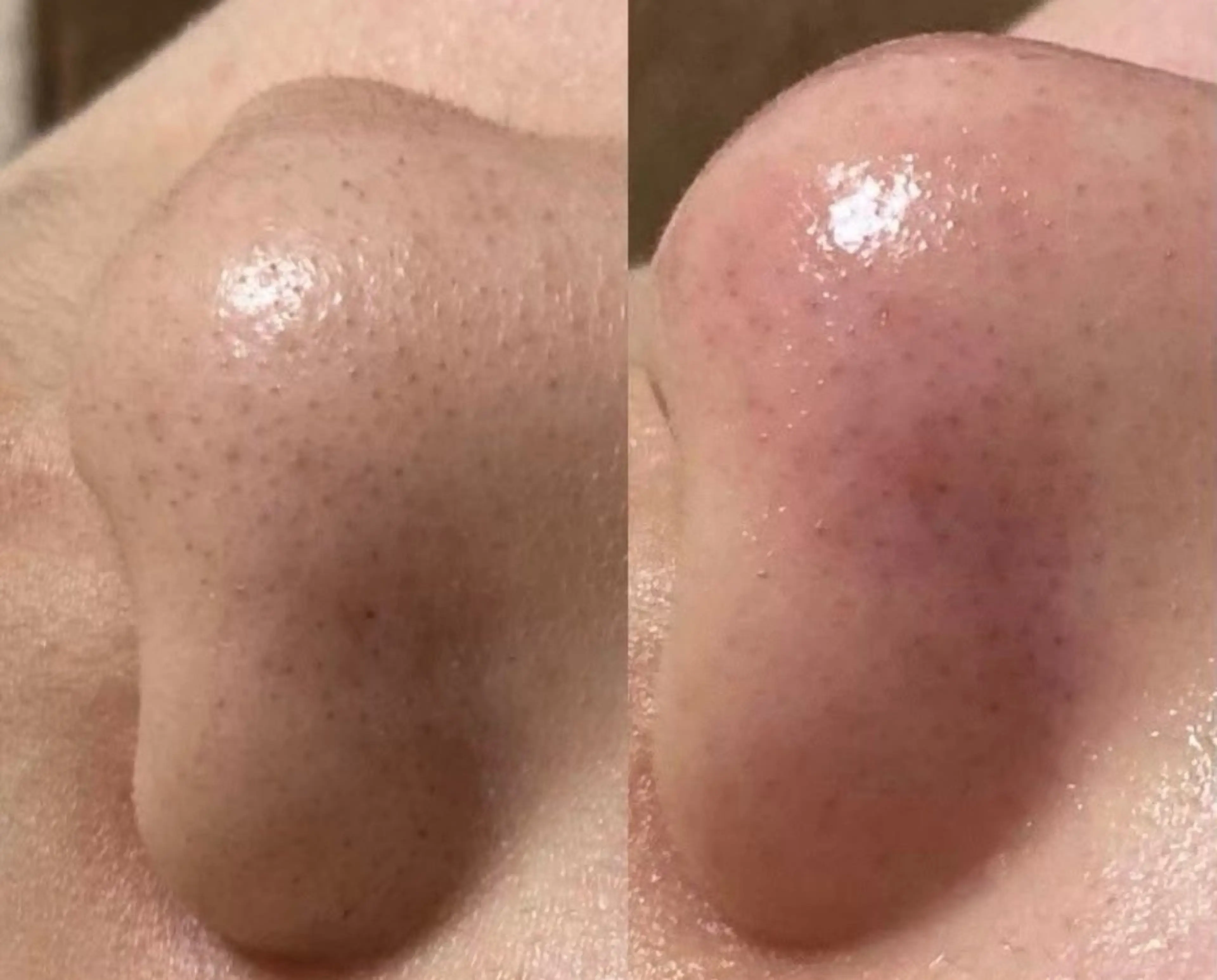 👃【Wax小鼻脱毛】の写真