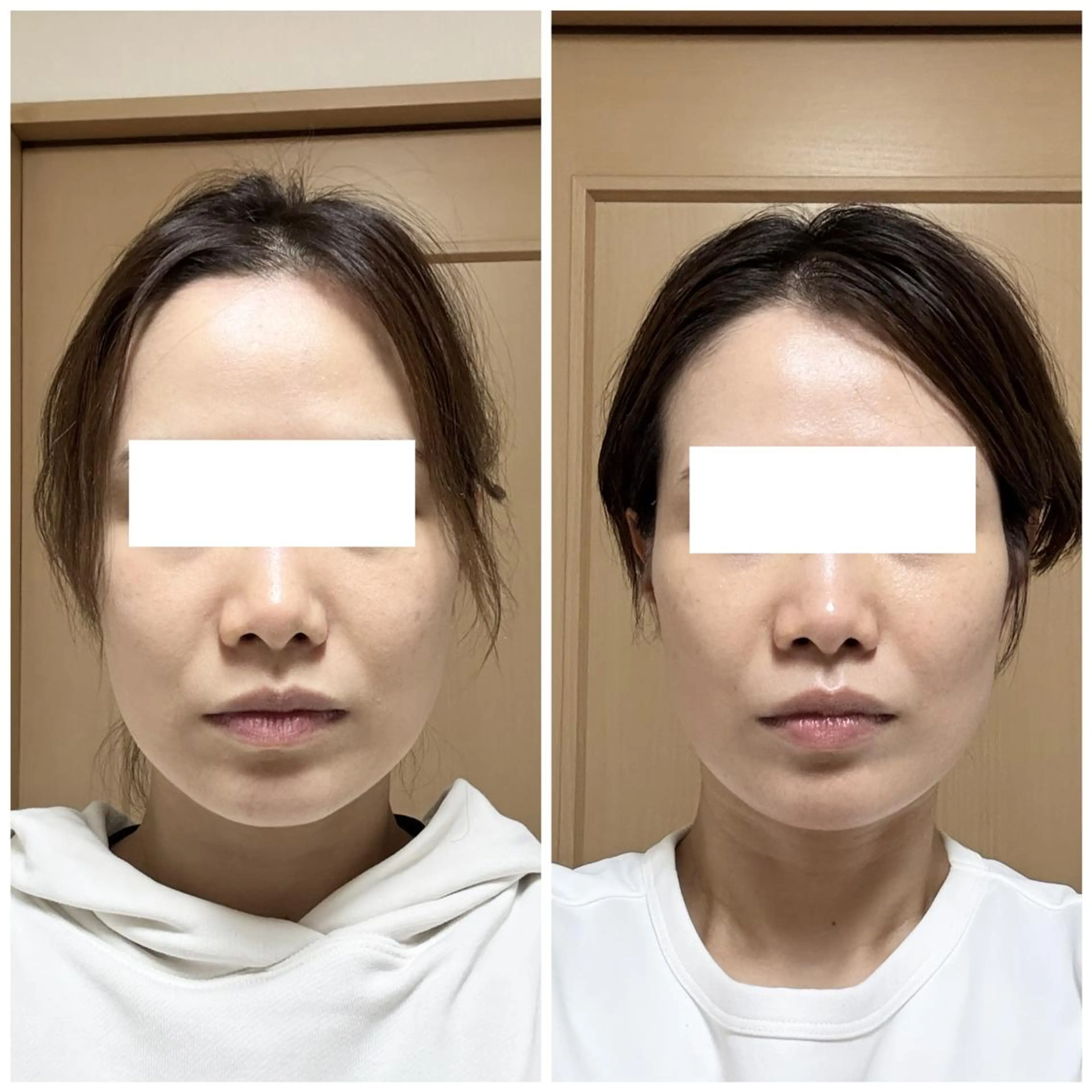 小顔整顔矯正の写真