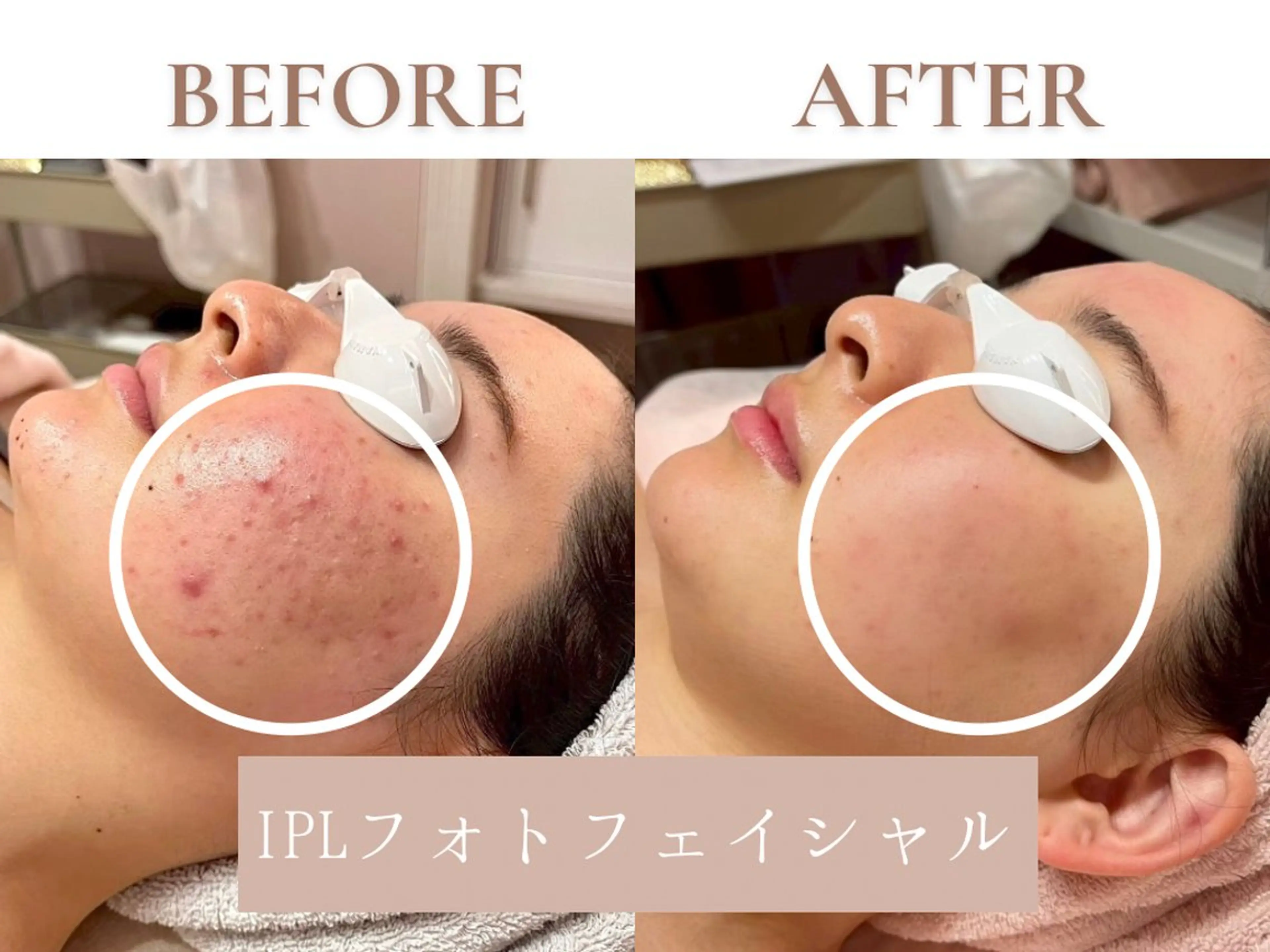 【ニキビケア🫧】肌質にアプローチ🌿¥5,500→¥2,750の写真