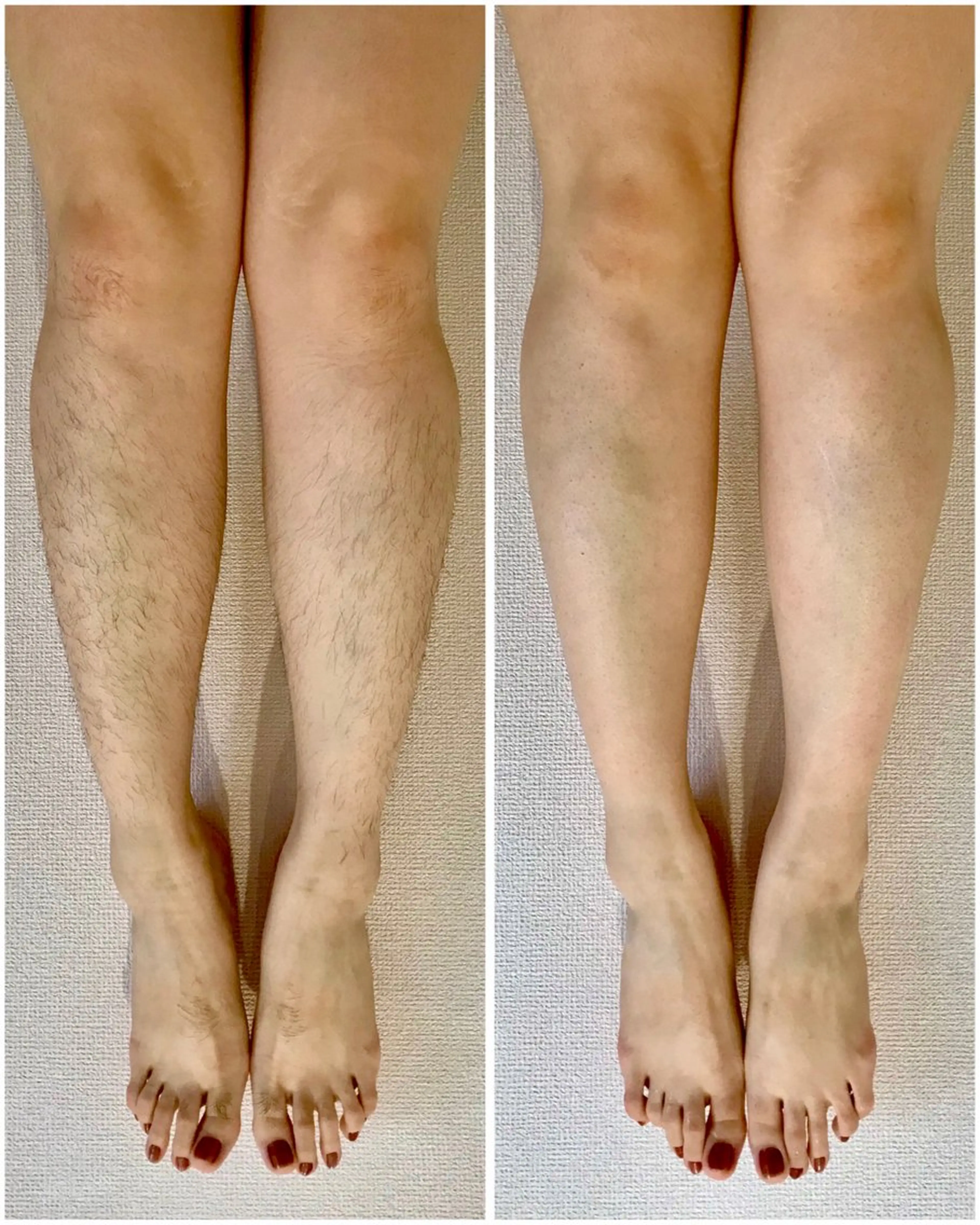 脱毛 nin feaのエステ・リラクイメージ