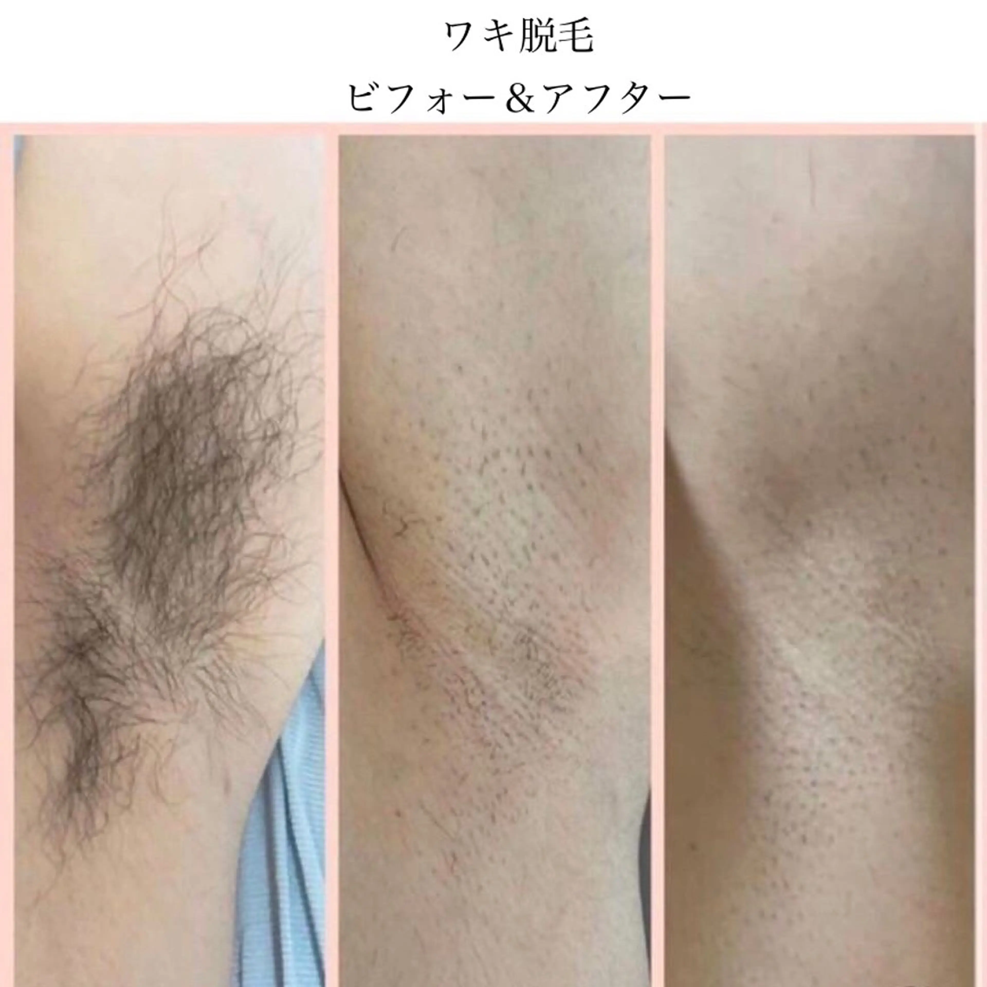 👨men's脱毛✨ワキ・ヒジ下・ヒザ下3点セットの写真