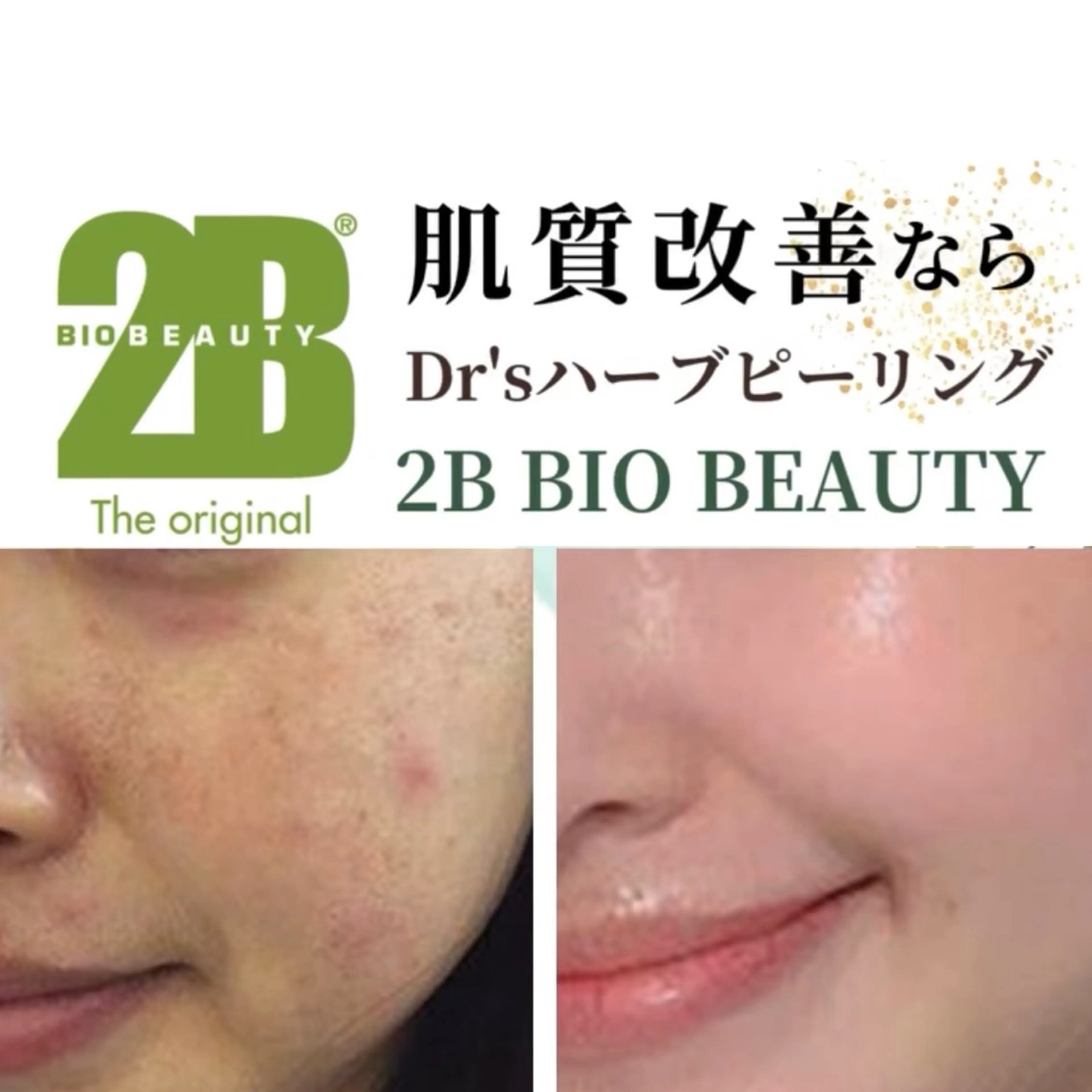 【2B BIOハーブピーリング】肌を土台からの改善◎深いシミ、シワ、ニキビ、毛穴の開きなどの根本的な肌悩みにアプローチ！の写真