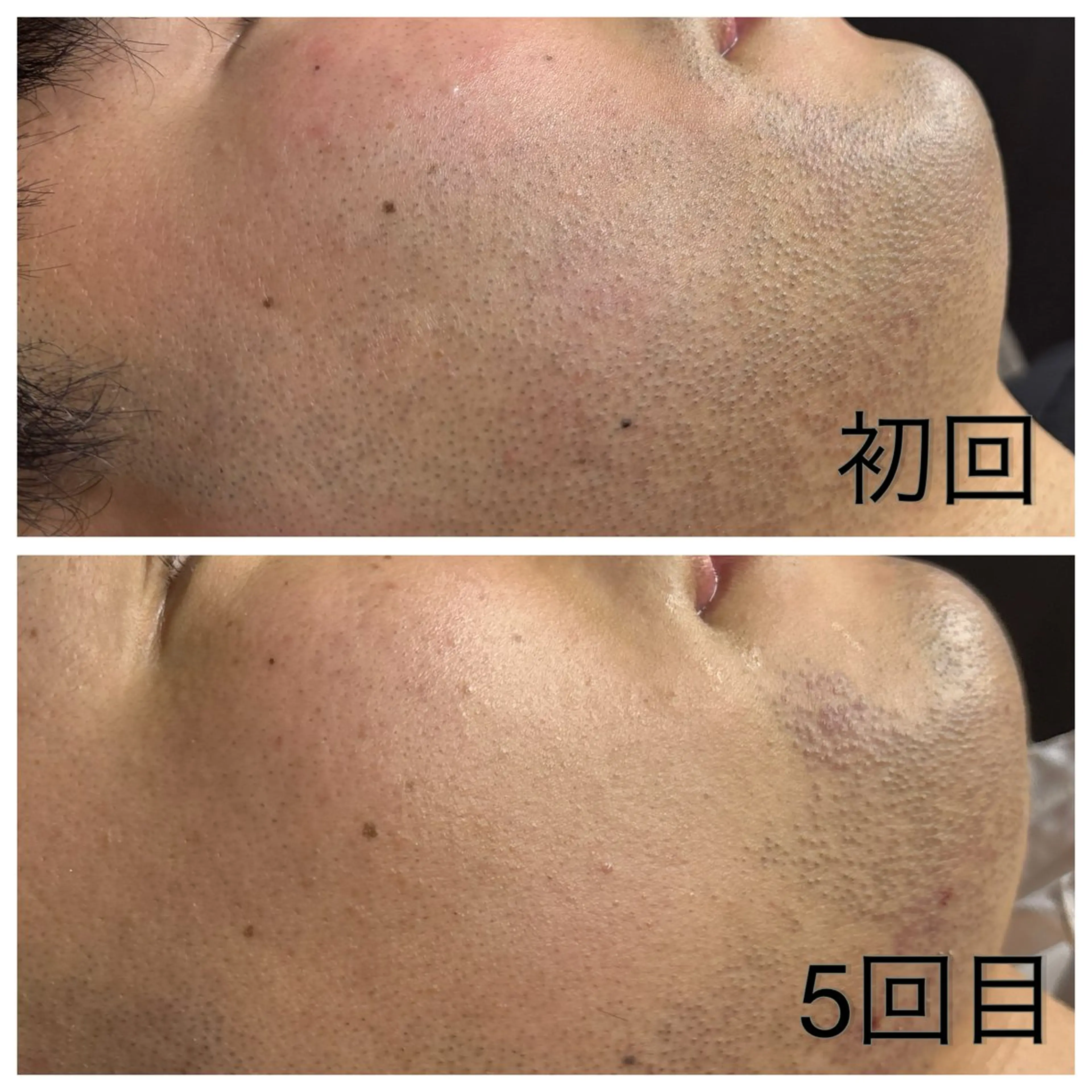 【初回限定💎】ヒゲ剃り卒業✨メンズヒゲ脱毛の写真