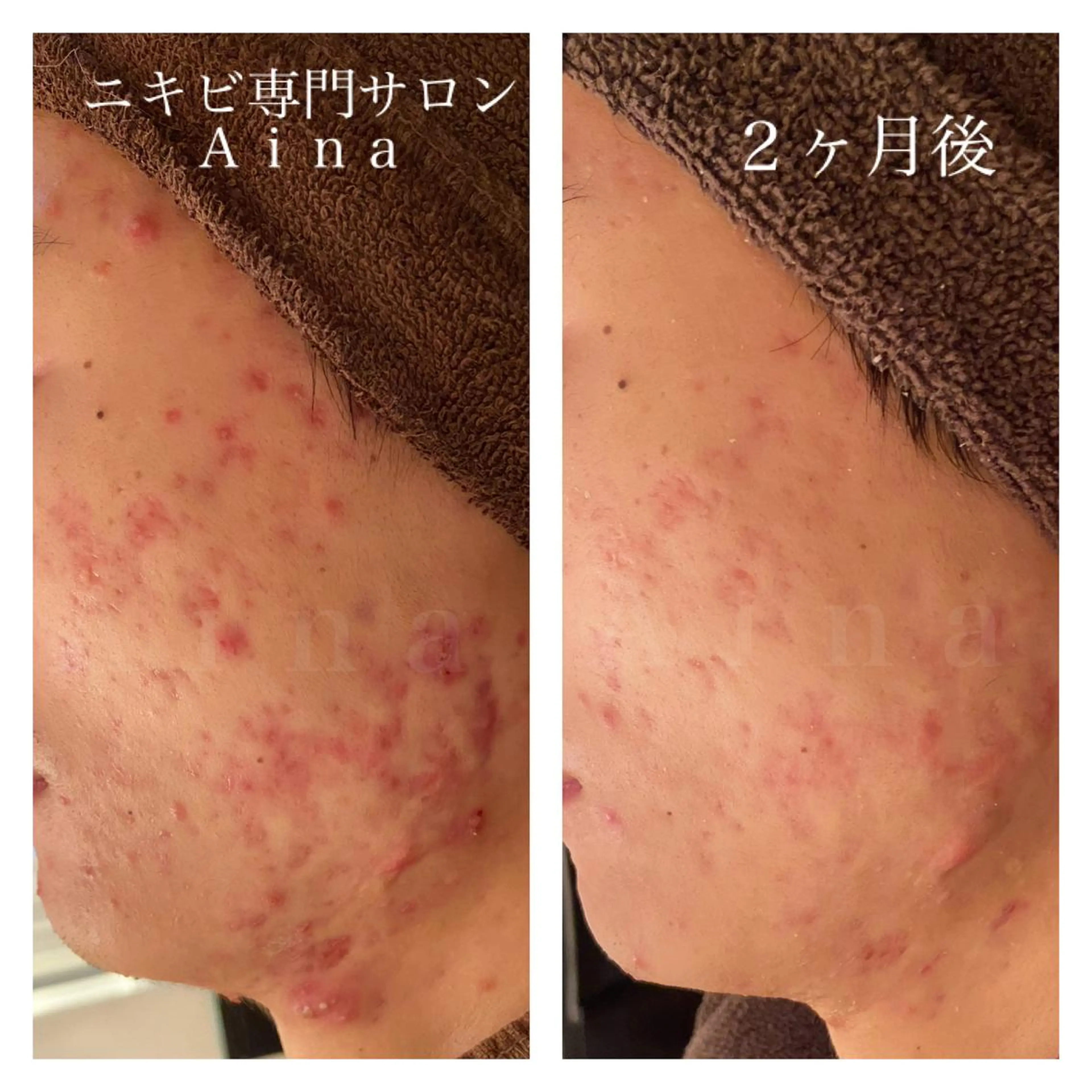 ロング カラー パーマ ヘアアレンジ メンズ キッズ ネイル マツエク・マツパ ブルーカラー ブルー 赤色 エステ リラク ニキビ跡専門サロン Ａｉｎａのエステ・リラクイメージ