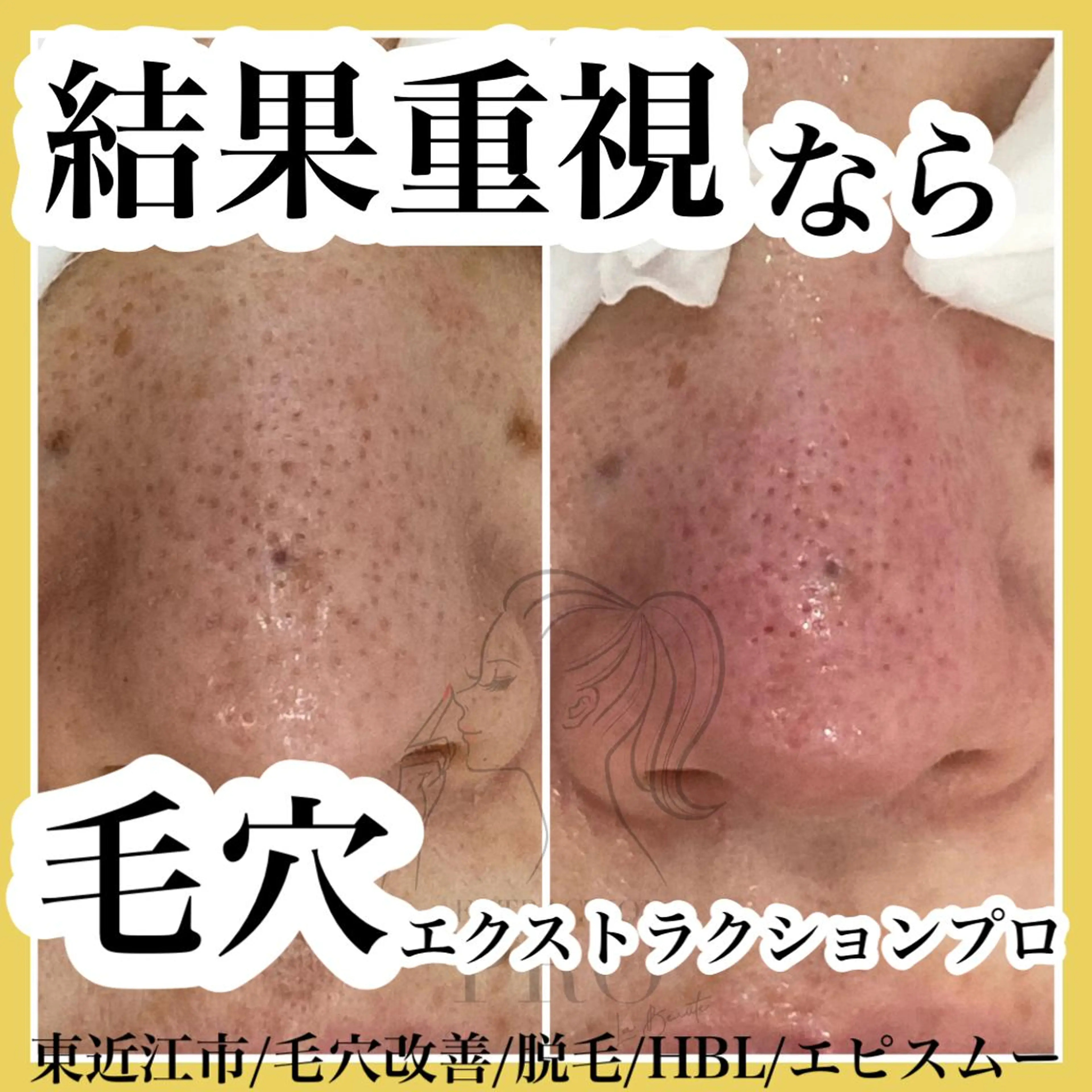 epismoo 脱毛/HBL/毛穴の眉毛・アイブロウイメージ