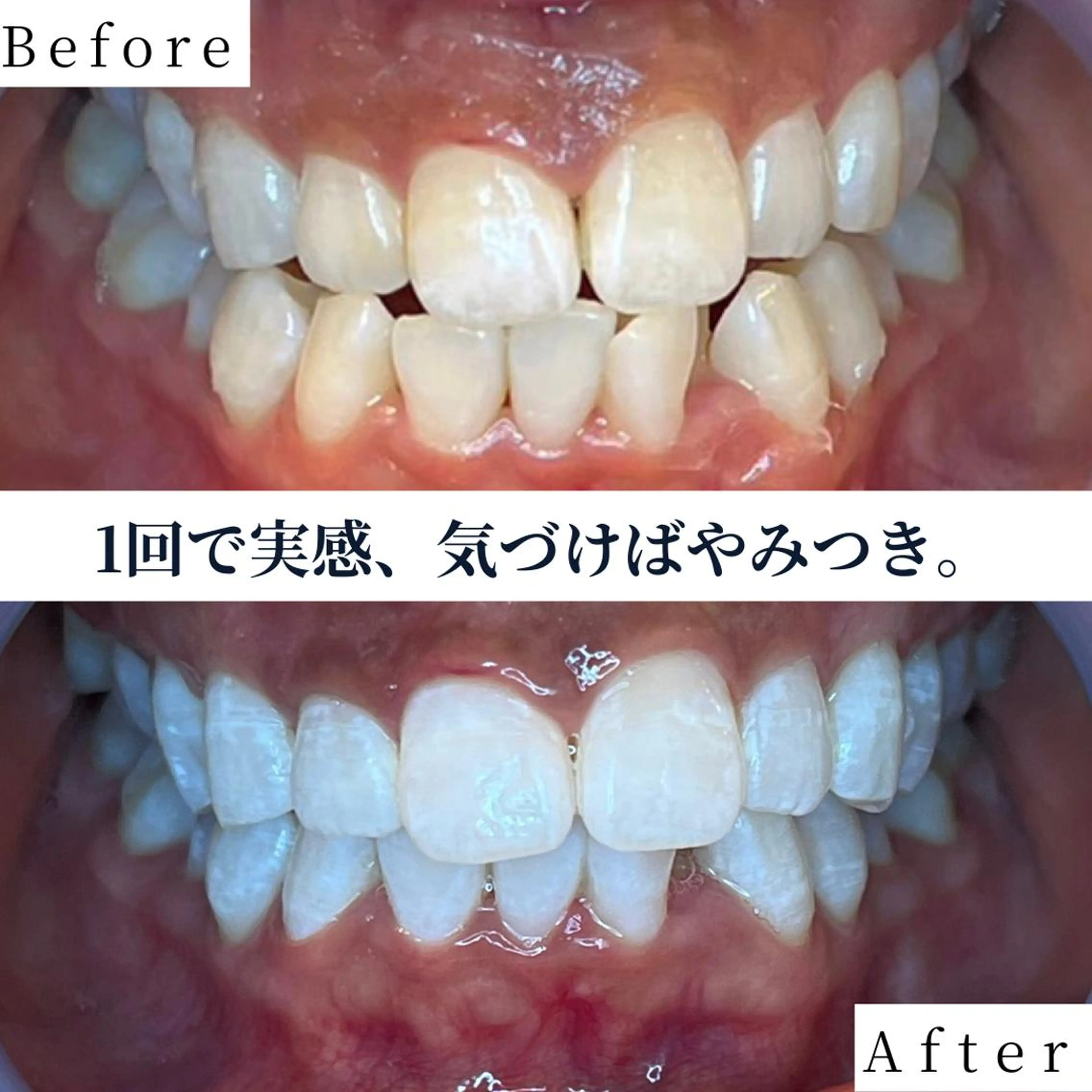 【効果実感★】超美白セルフホワイトニング40分照射🦷✨¥6,980→¥2,980の写真