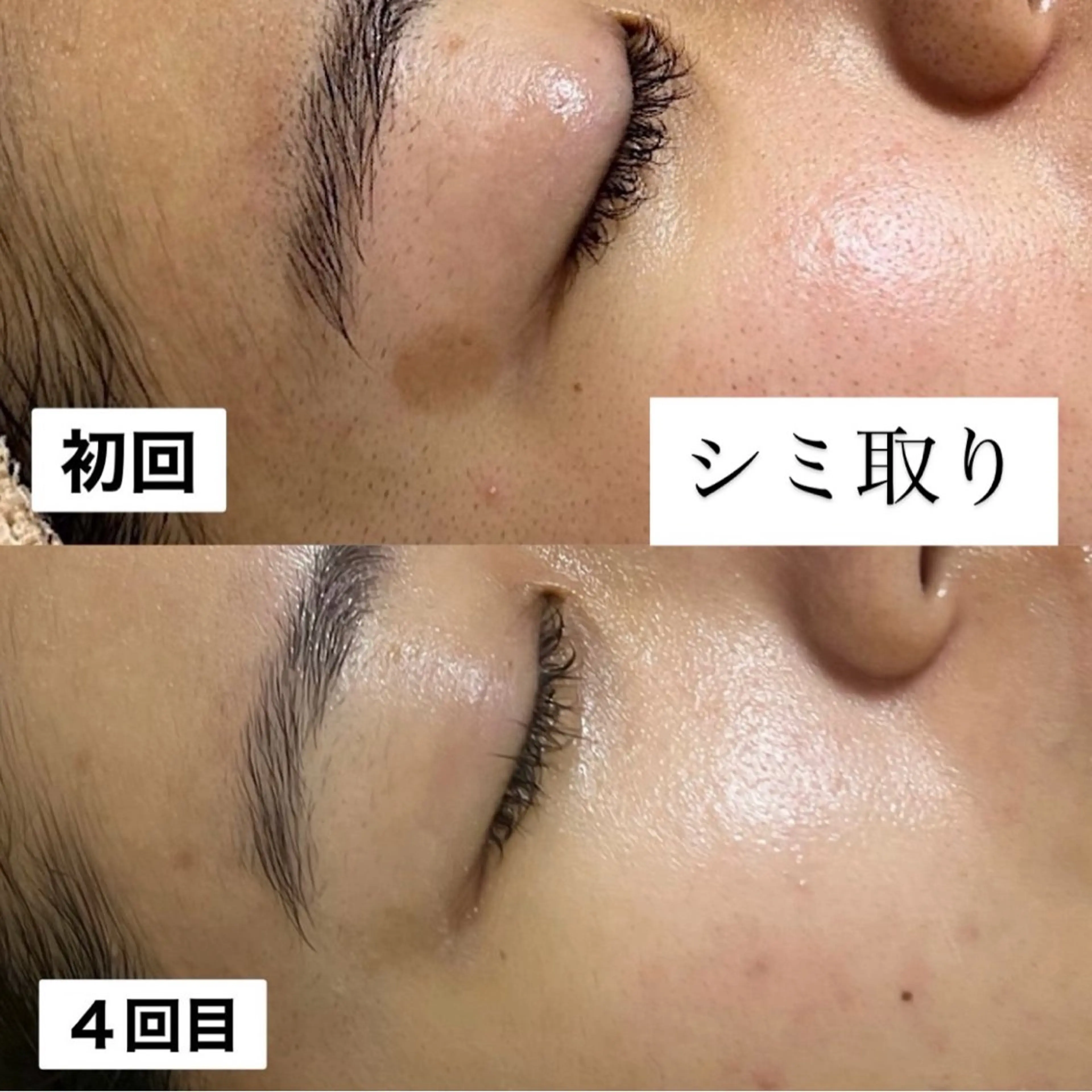 【シミ30分取り放題】最新シミケアマシーン！【練習モデル】の写真