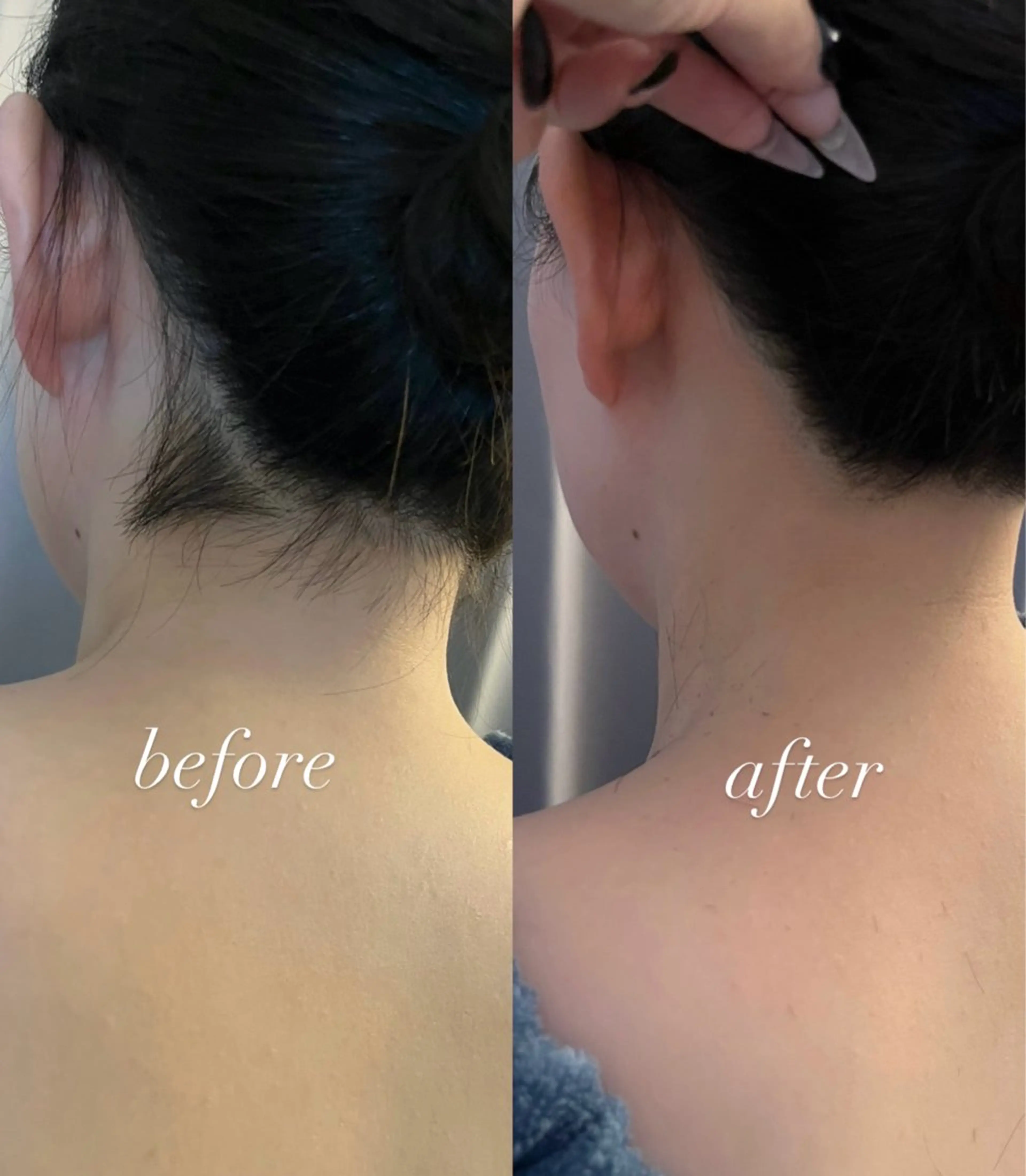 脱毛 うなじ脱毛/美肌脱毛 LABELのエステ・リラクイメージ