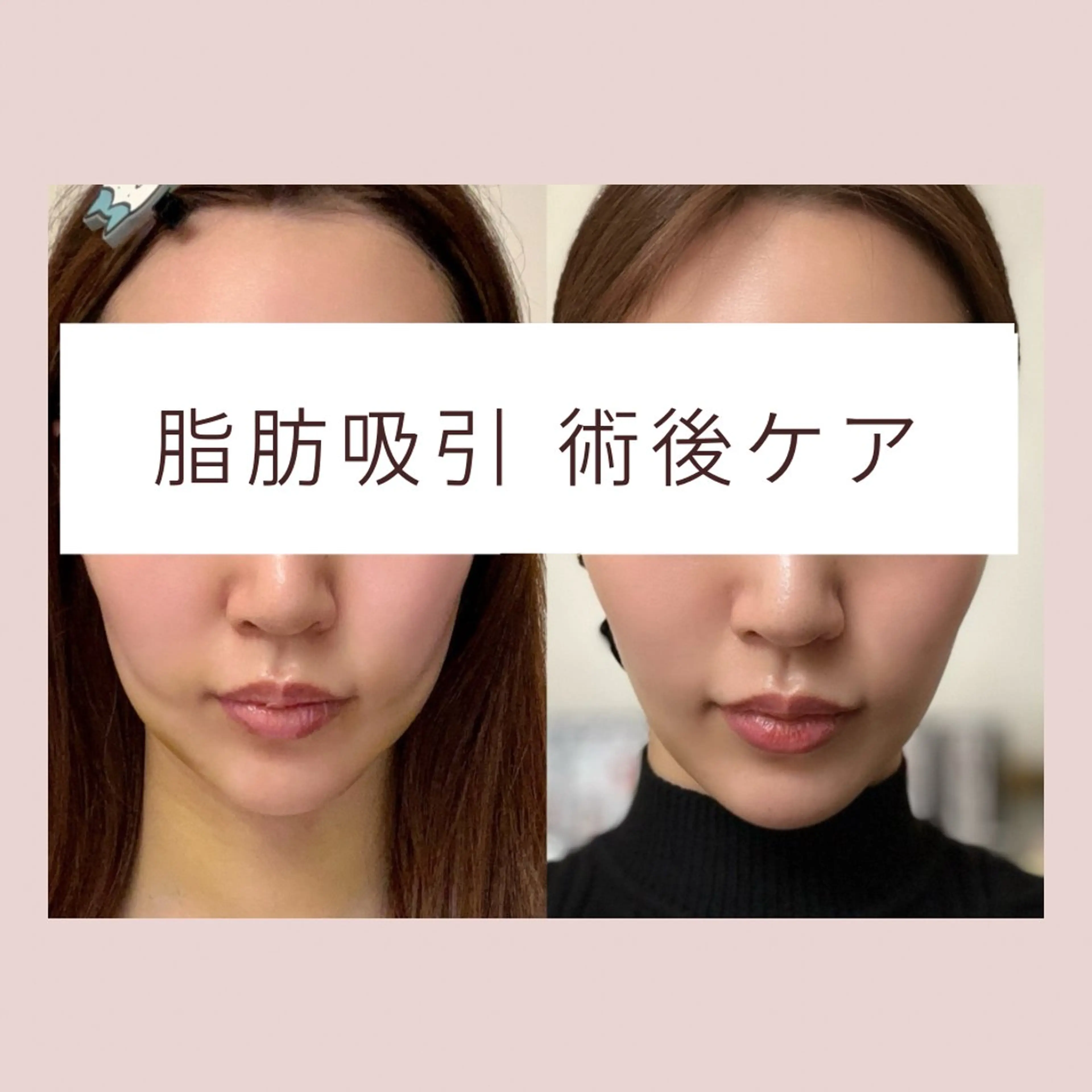 ミニモ限定🌻【拘縮緩和】脂肪吸引✨️術後ケア✨️30分の写真