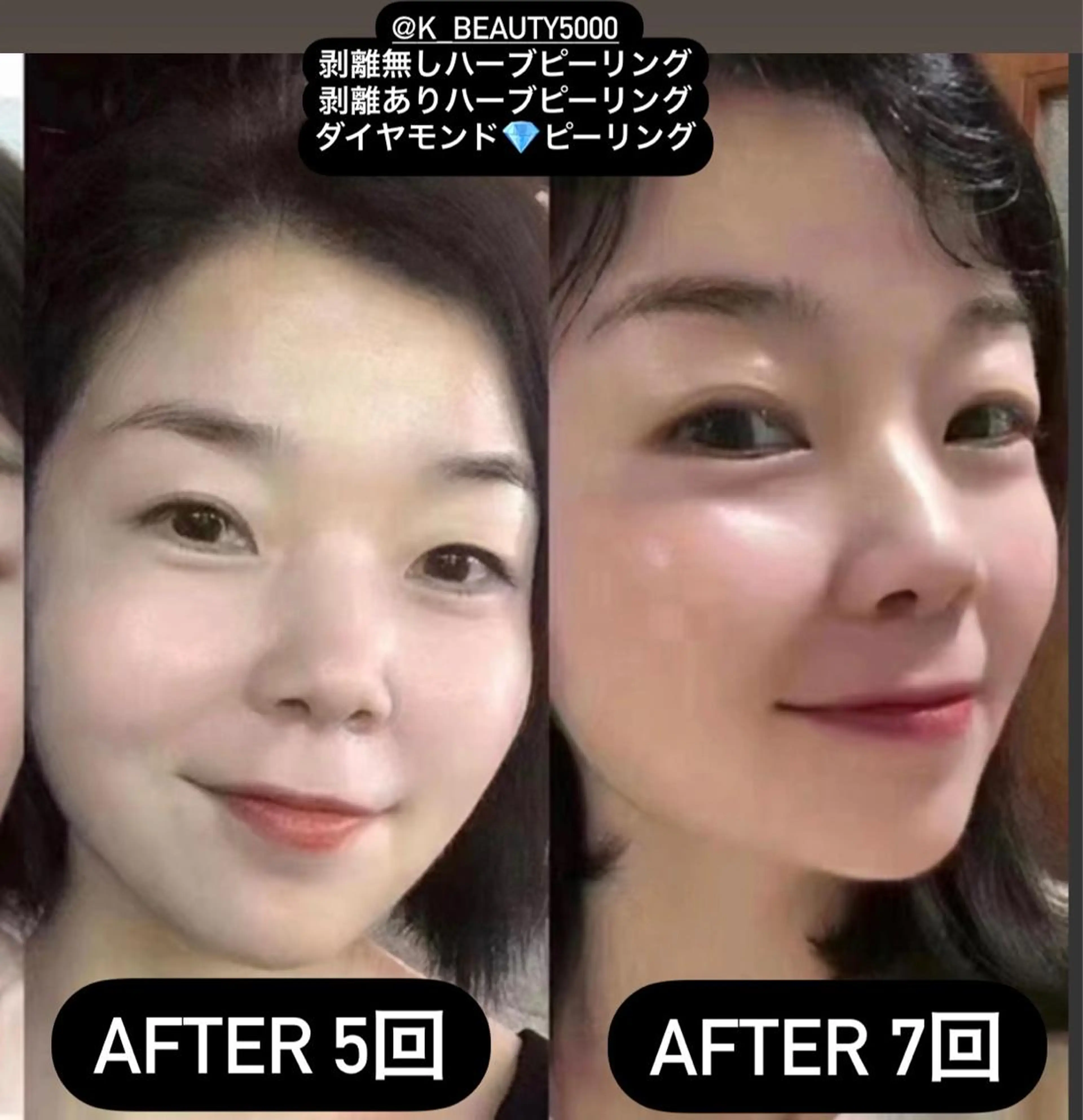 エステ 【ハイパーナイフ痩身&小顔コルギ&ハーブピーリング】K-Beauty 東新宿所属・kーbeauty痩身 フェイシャルのエステ・リラクイメージ