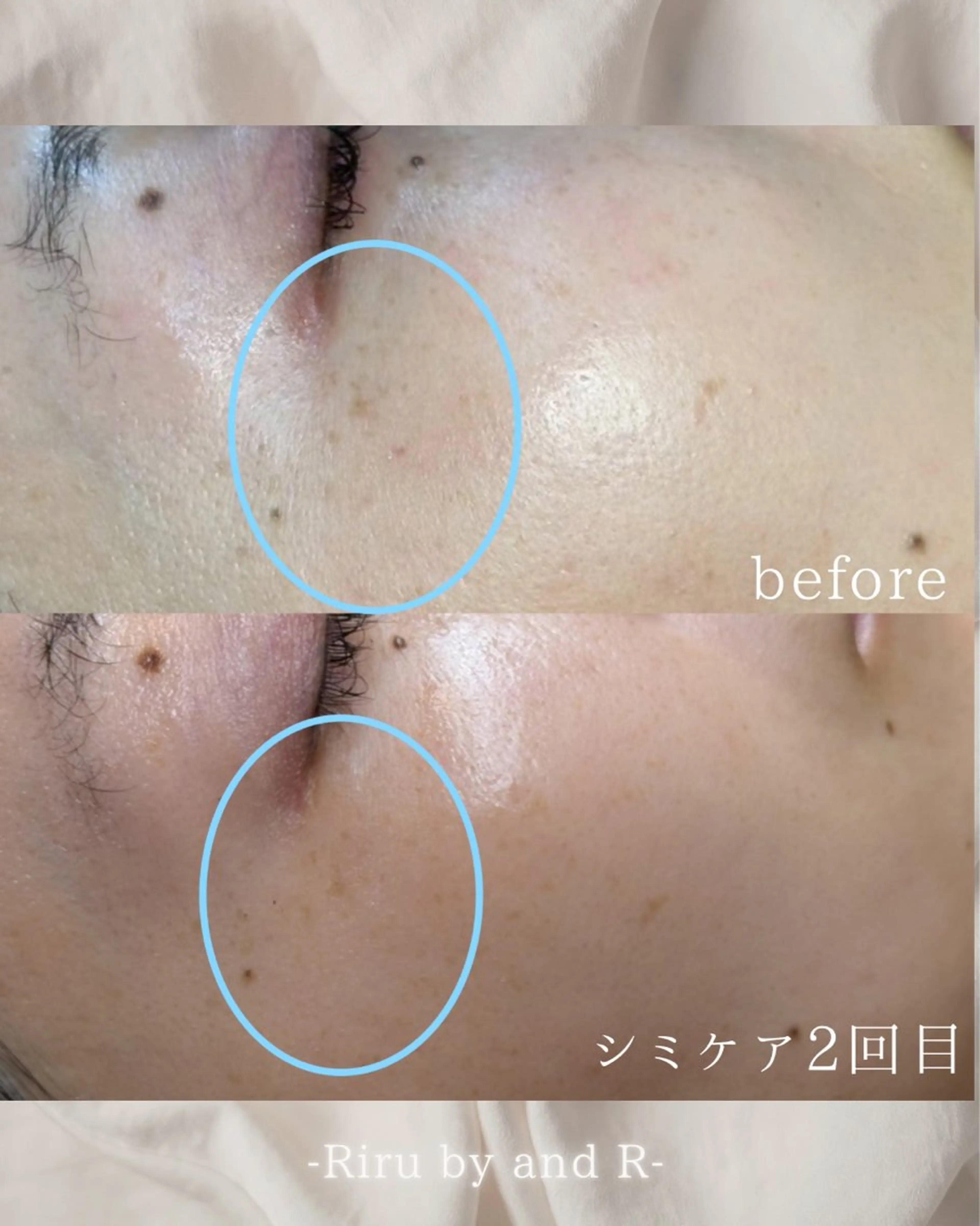 【本日限定!!】【新規人気No.1☆】肌質改善シミケア《プレミアムコース》90分16,500→8,800の写真