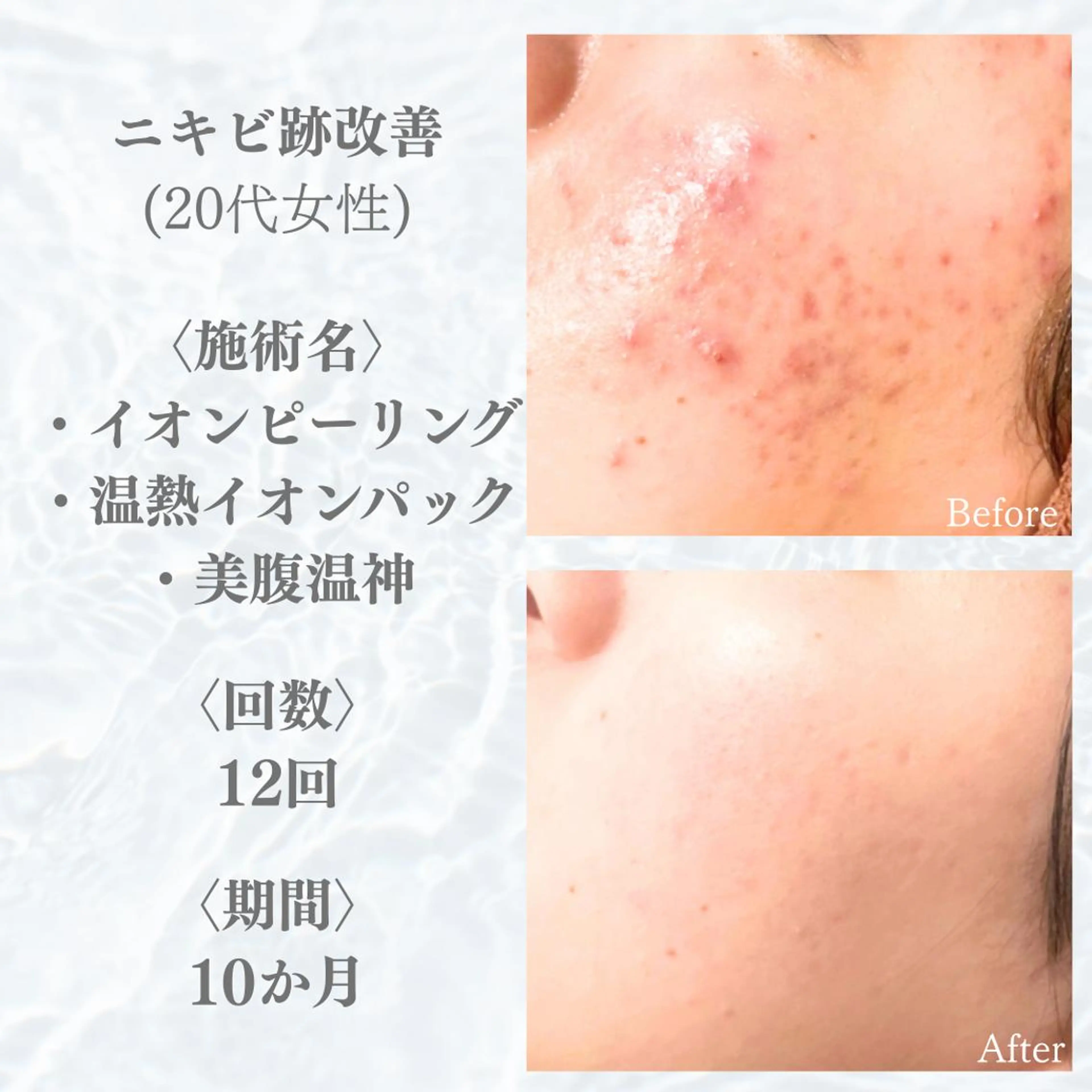 【🧡お得すぎる2回セット🧡】効果を見極めたい人！ピーリング＋Wパック＋ボディケアコース2回分（ニキビに即効性）の写真