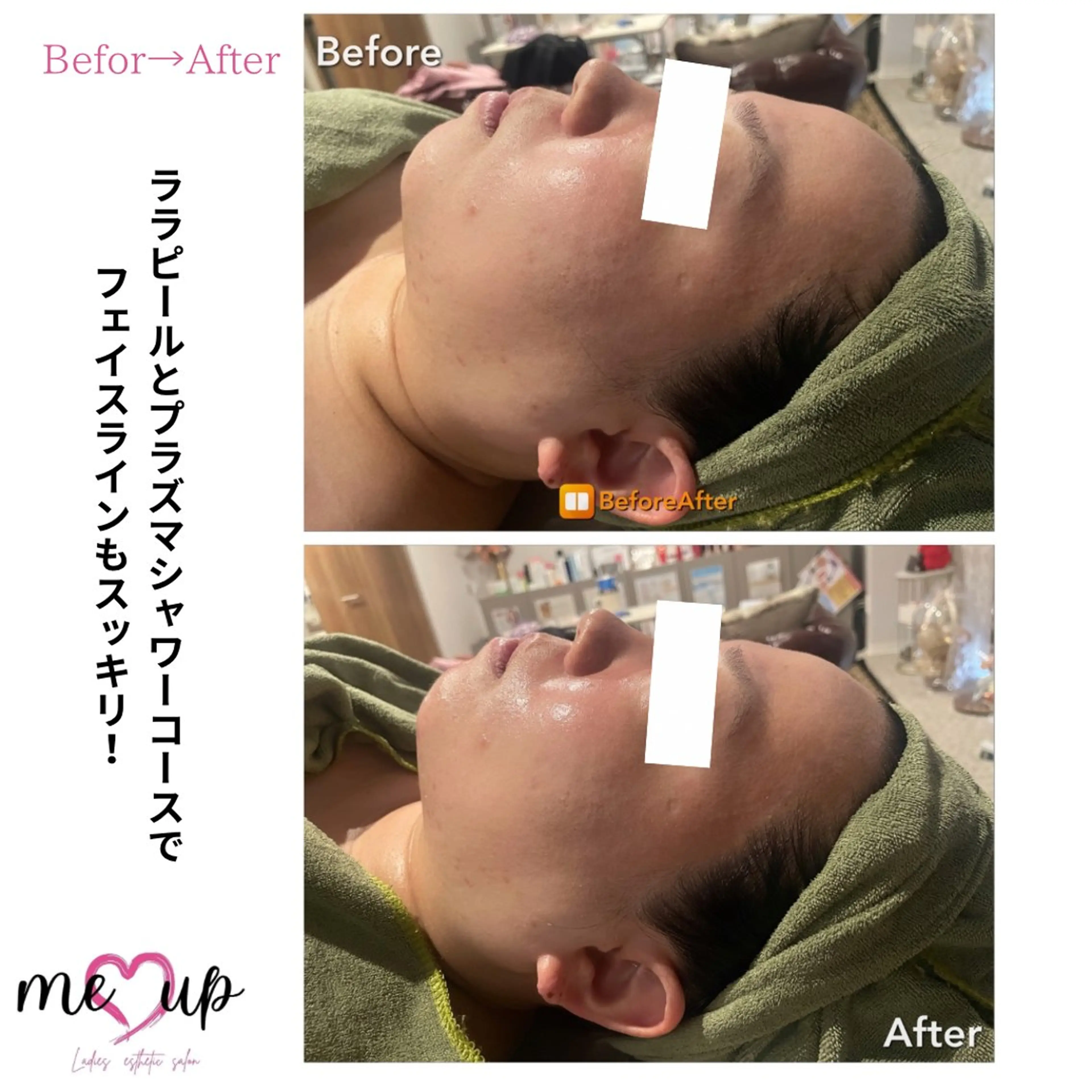 エステ Meupニキビ専門店 背中/ハーブ/ララのその他イメージ