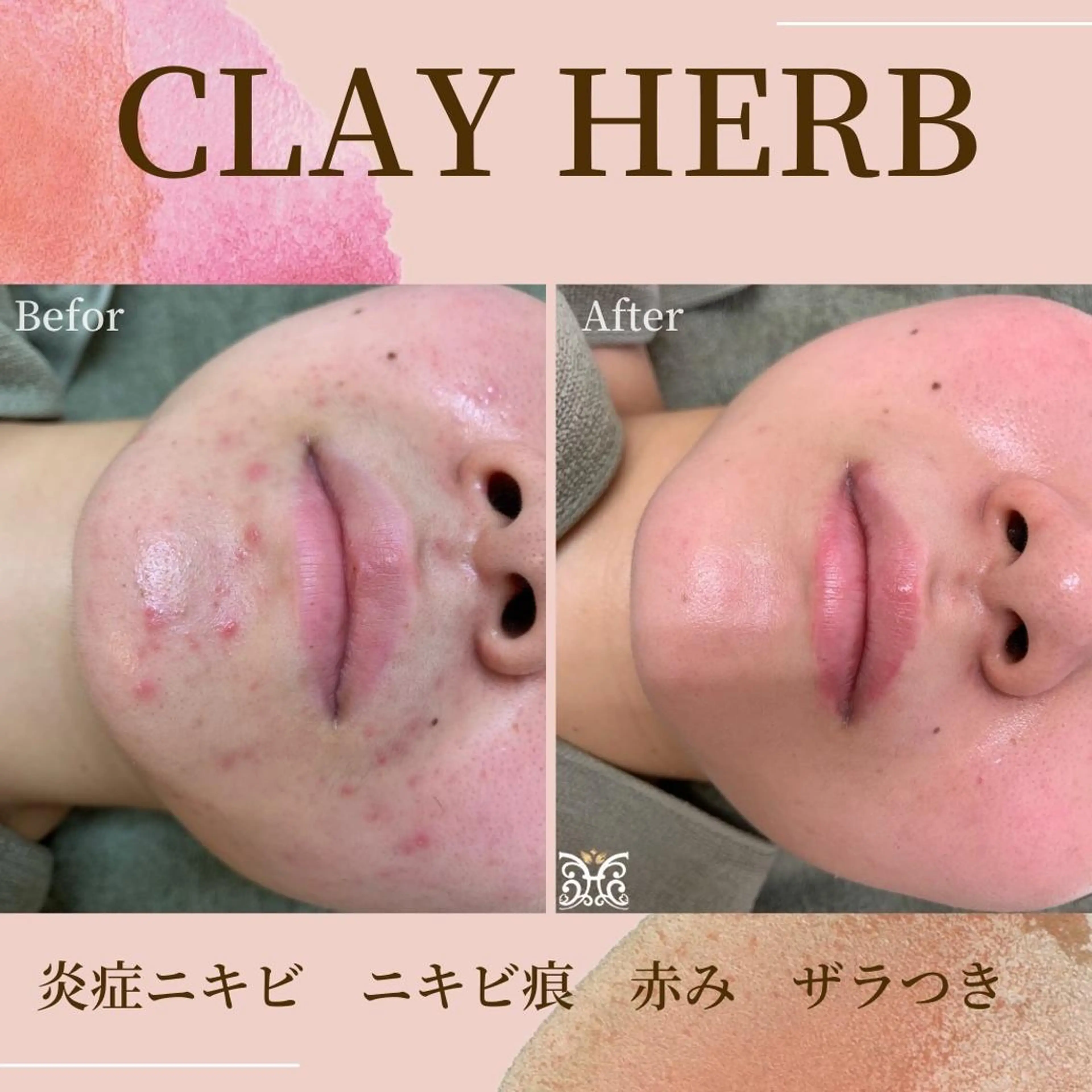 エステ リラク 【剥離ありハーブピーリング専門エステ】cerisier BEAUTÉ 原宿所属・cerisier BEAUTÉのエステ・リラクイメージ