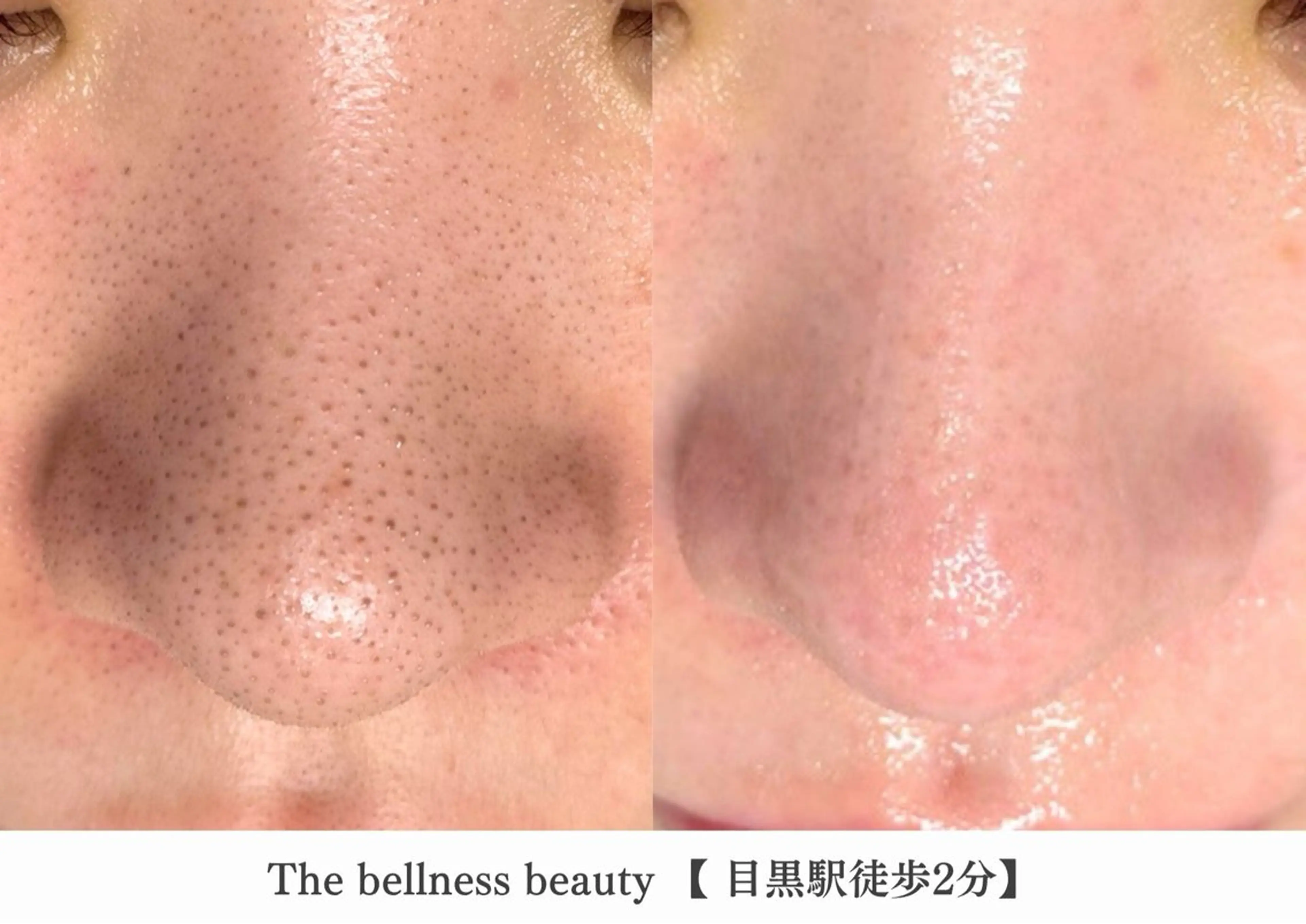 エステ 《毛穴レス美肌》ザ・ ベルネス 目黒駅2分のエステ・リラクイメージ