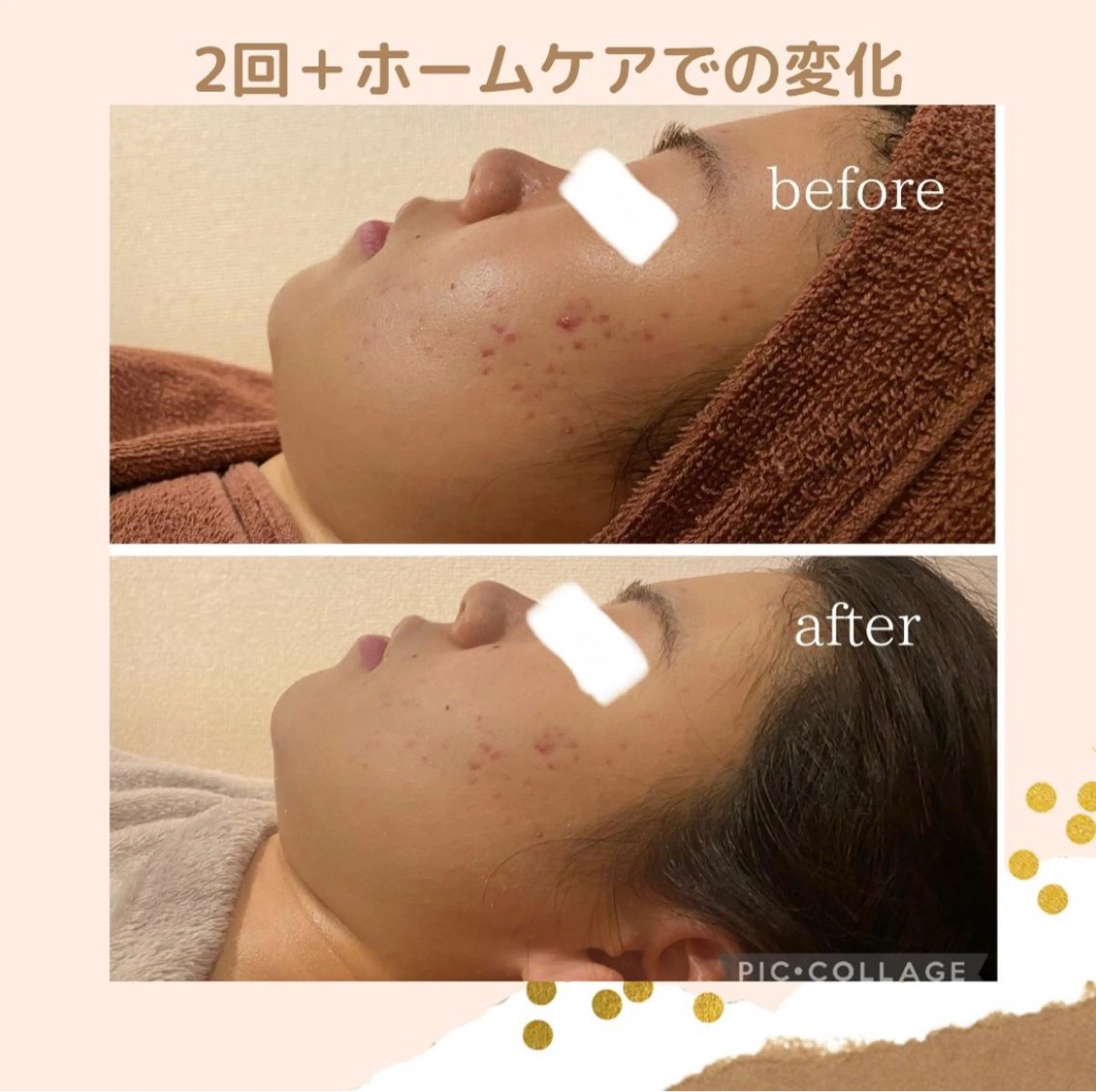 学生ニキビ改善🍀 優しい肌質改善のエステ・リラクイメージ