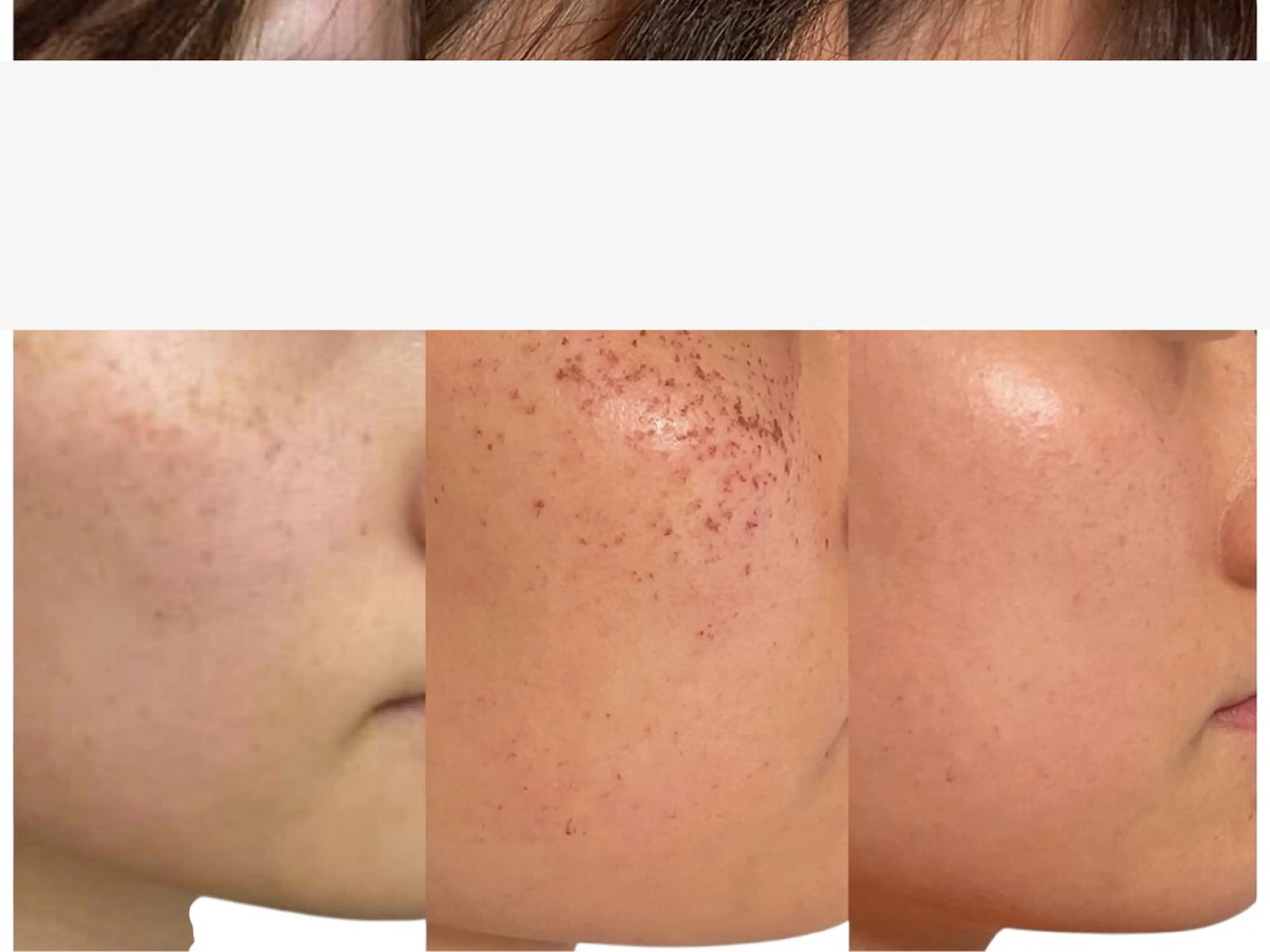 IPL、光フォト＋リジェセル（美肌薬剤導入）の写真