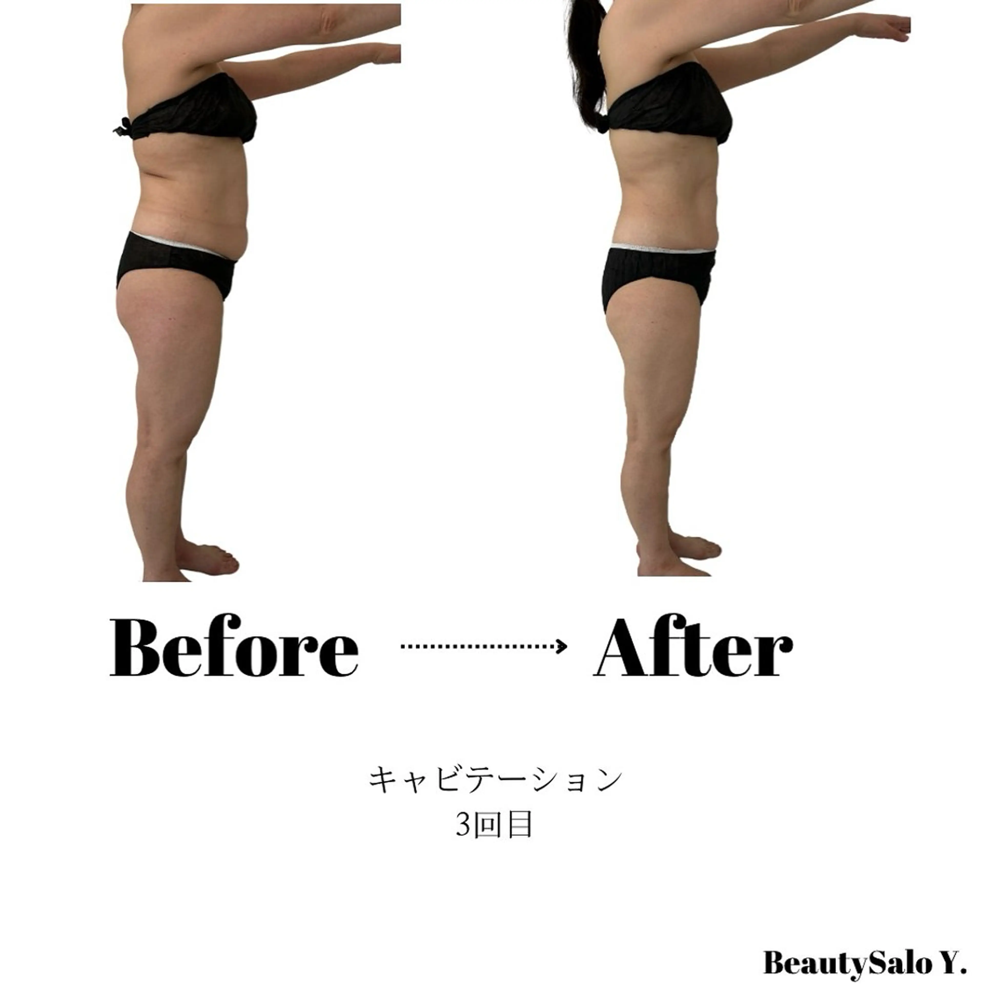 【全身みっちり脂肪を落としたい方におすすめ】脂肪を落とすキャビテーション&ダイエットリンパマッサージ120分の写真