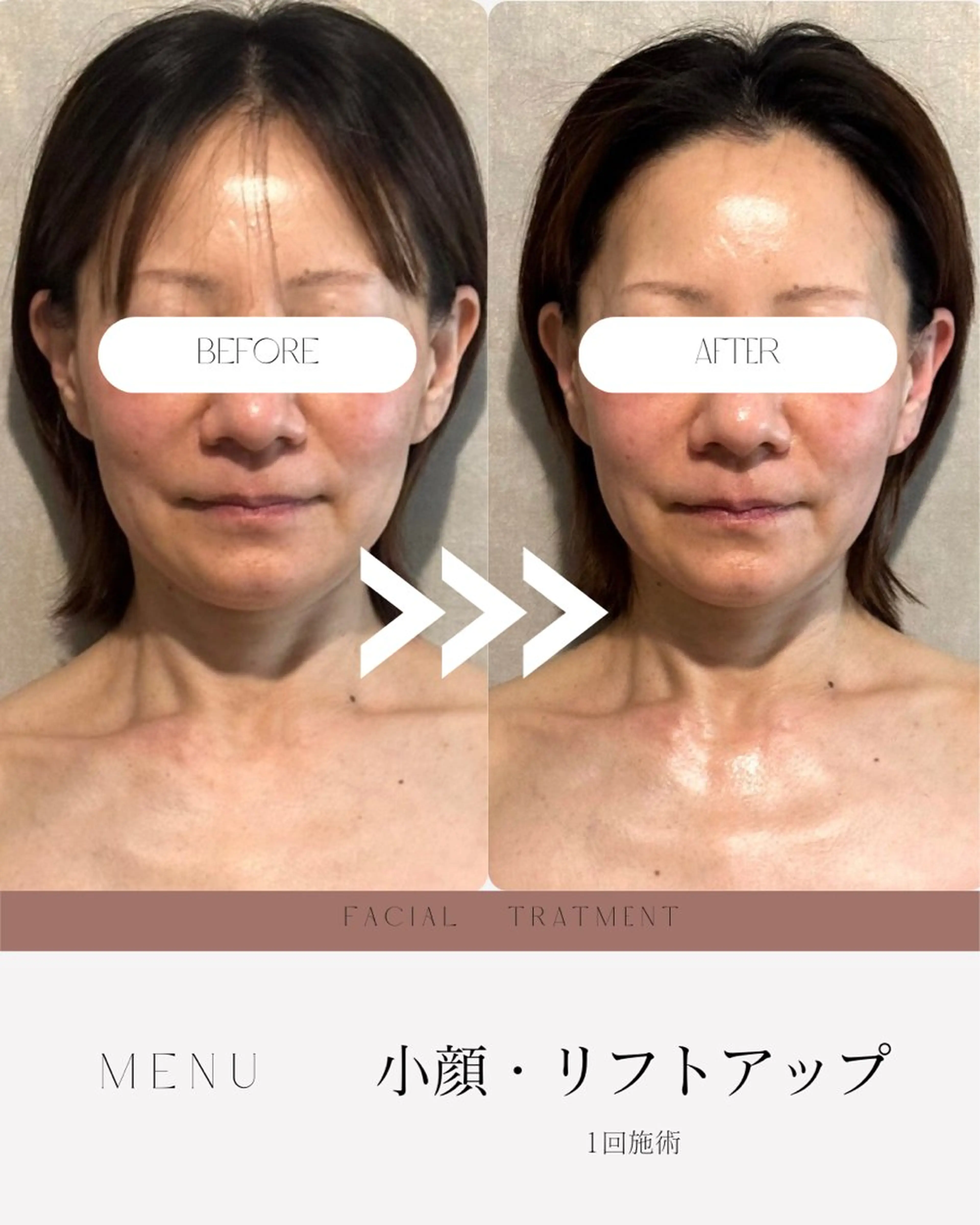 🌼小顔🌼🔻たるみ・マリオネット線改善🔻《背中・デコルテマッサージ付》※機械使用の写真