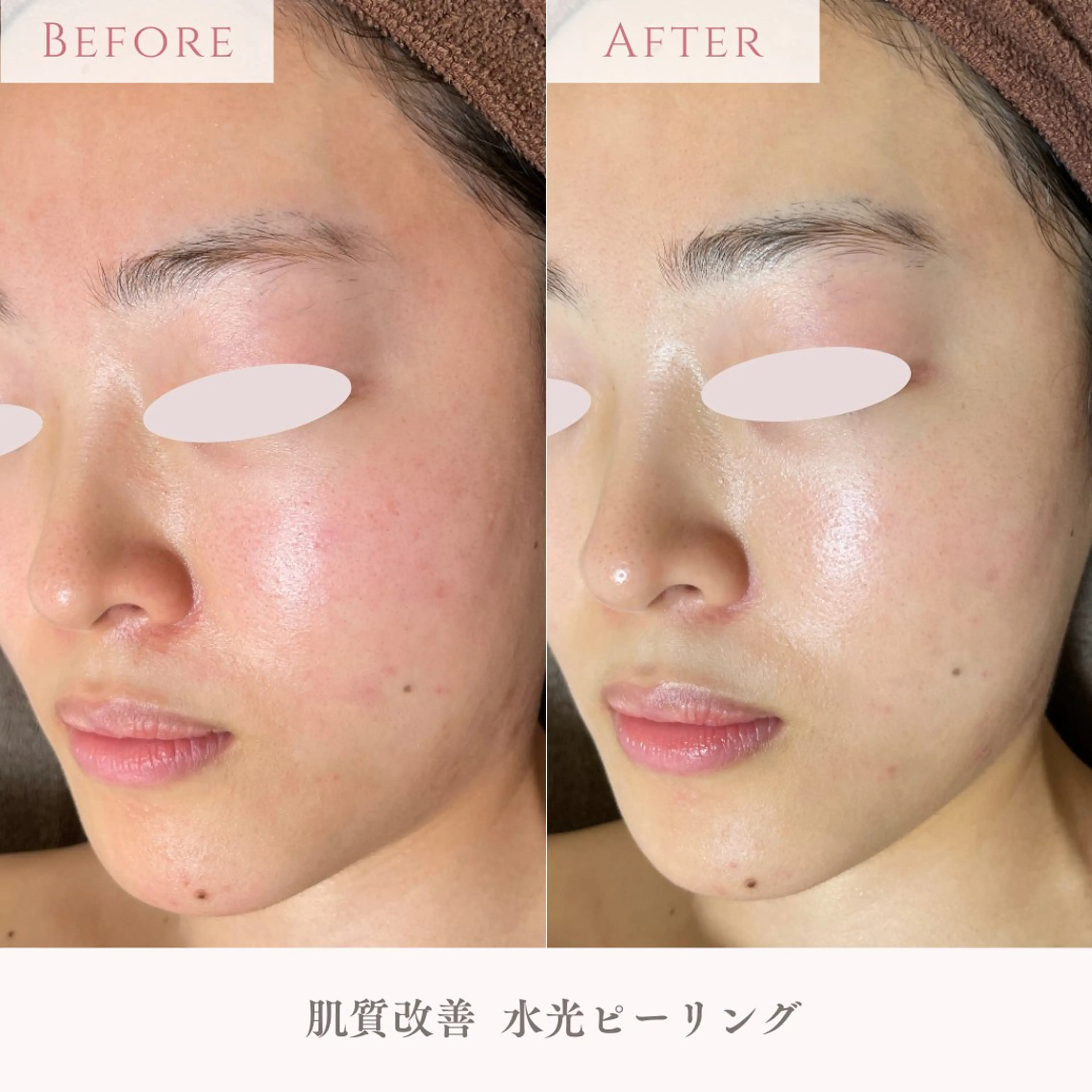 【毎月先着3名様限定！】内側から輝く水光肌になりたい方へ💎うるツヤ水光肌コース マッサージ付70分の写真