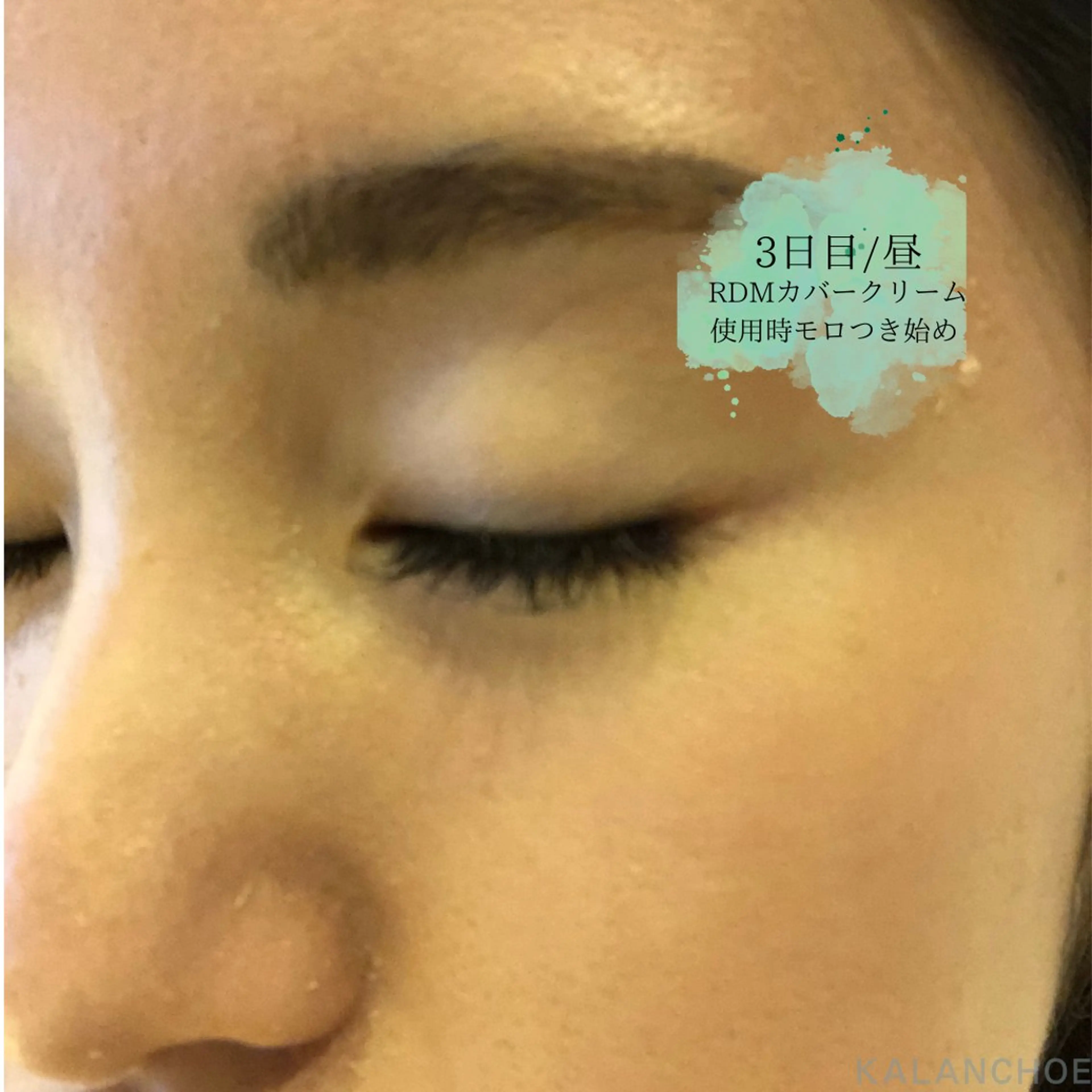 エステ 肌質改善 KALANCHOEのエステ・リラクイメージ