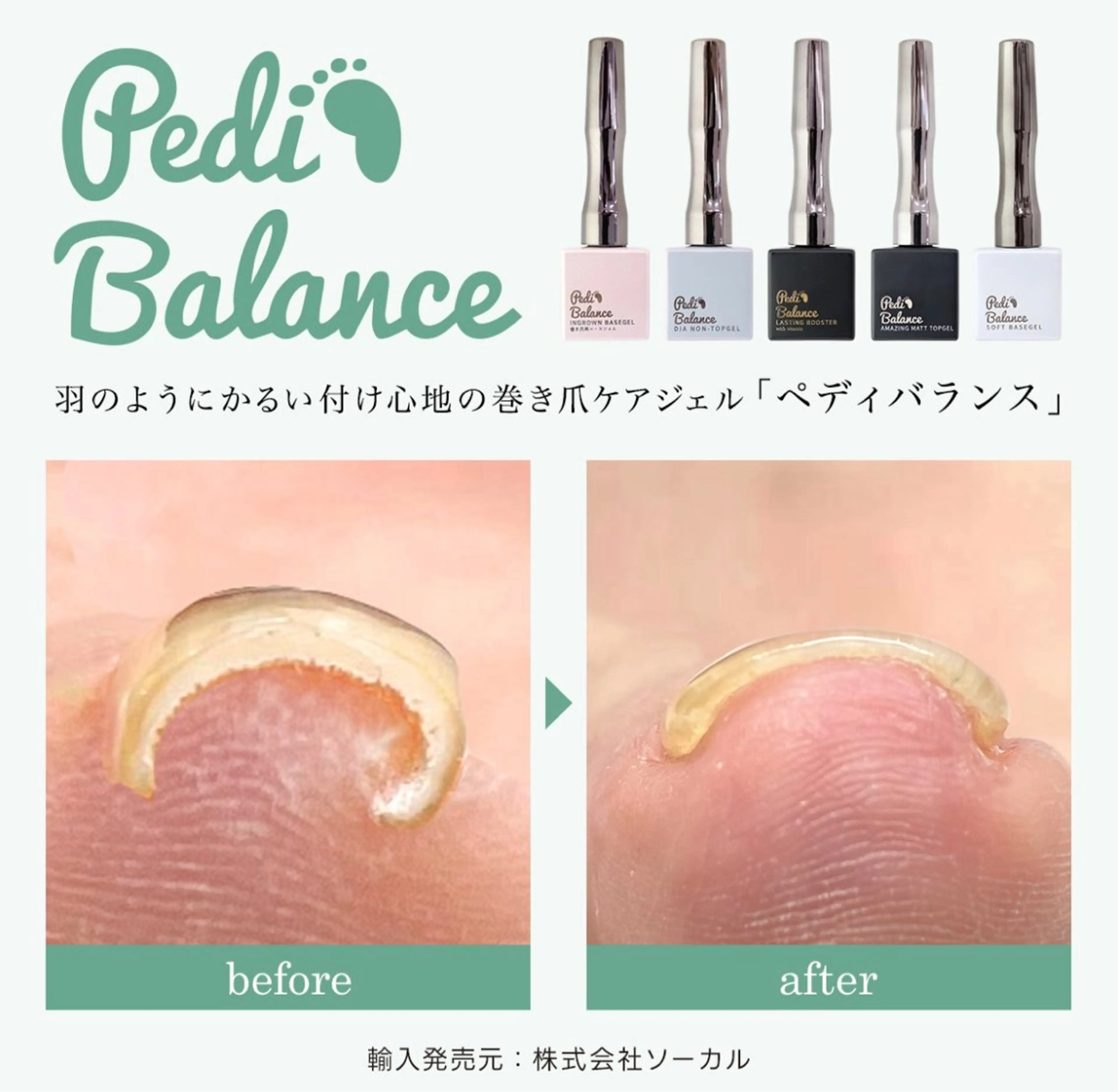 巻き爪ケア親指2本つき、フットネイルワンカラーの写真