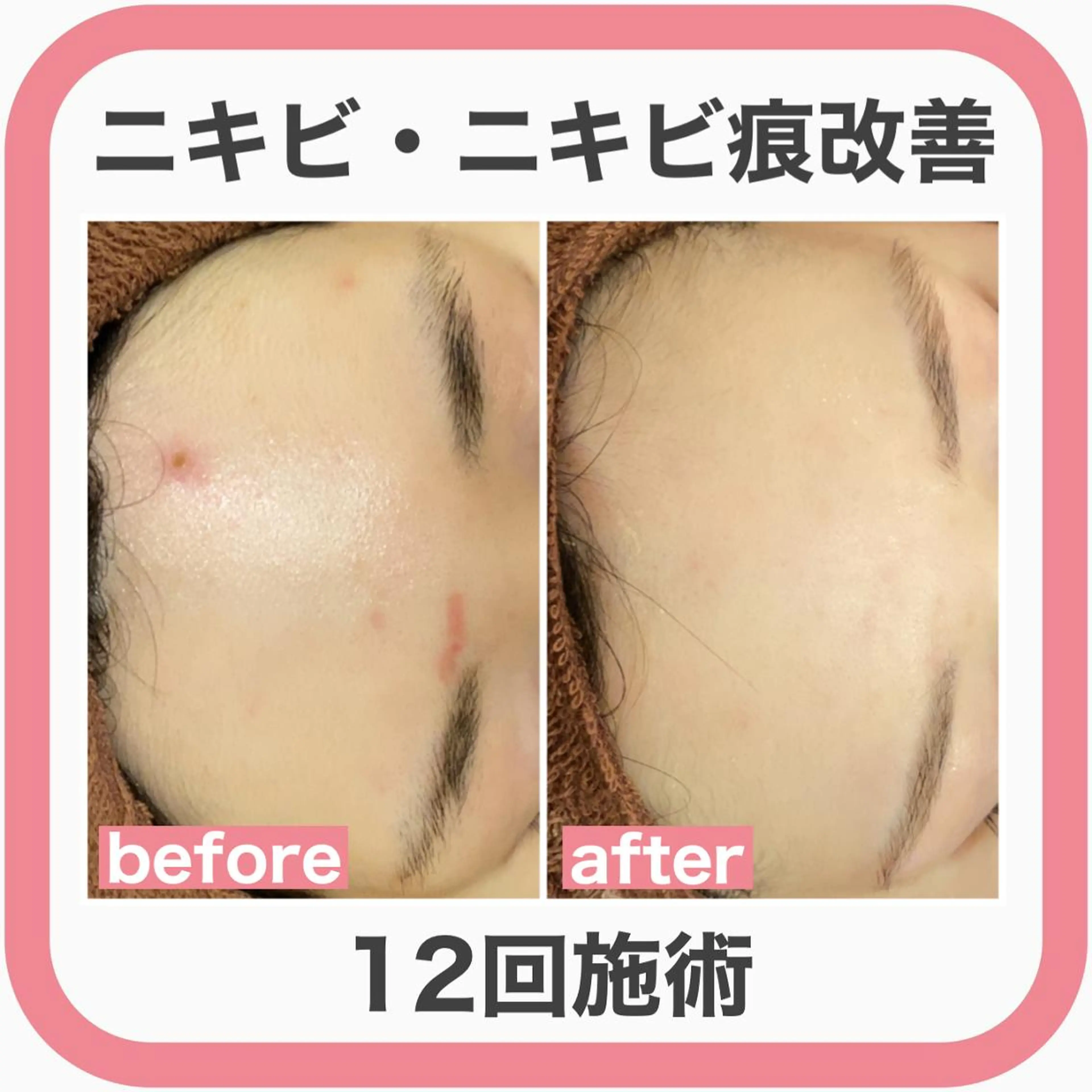 皮膚科より効果あり ⁉️最短ニキビ改善のエステ・リラクイメージ