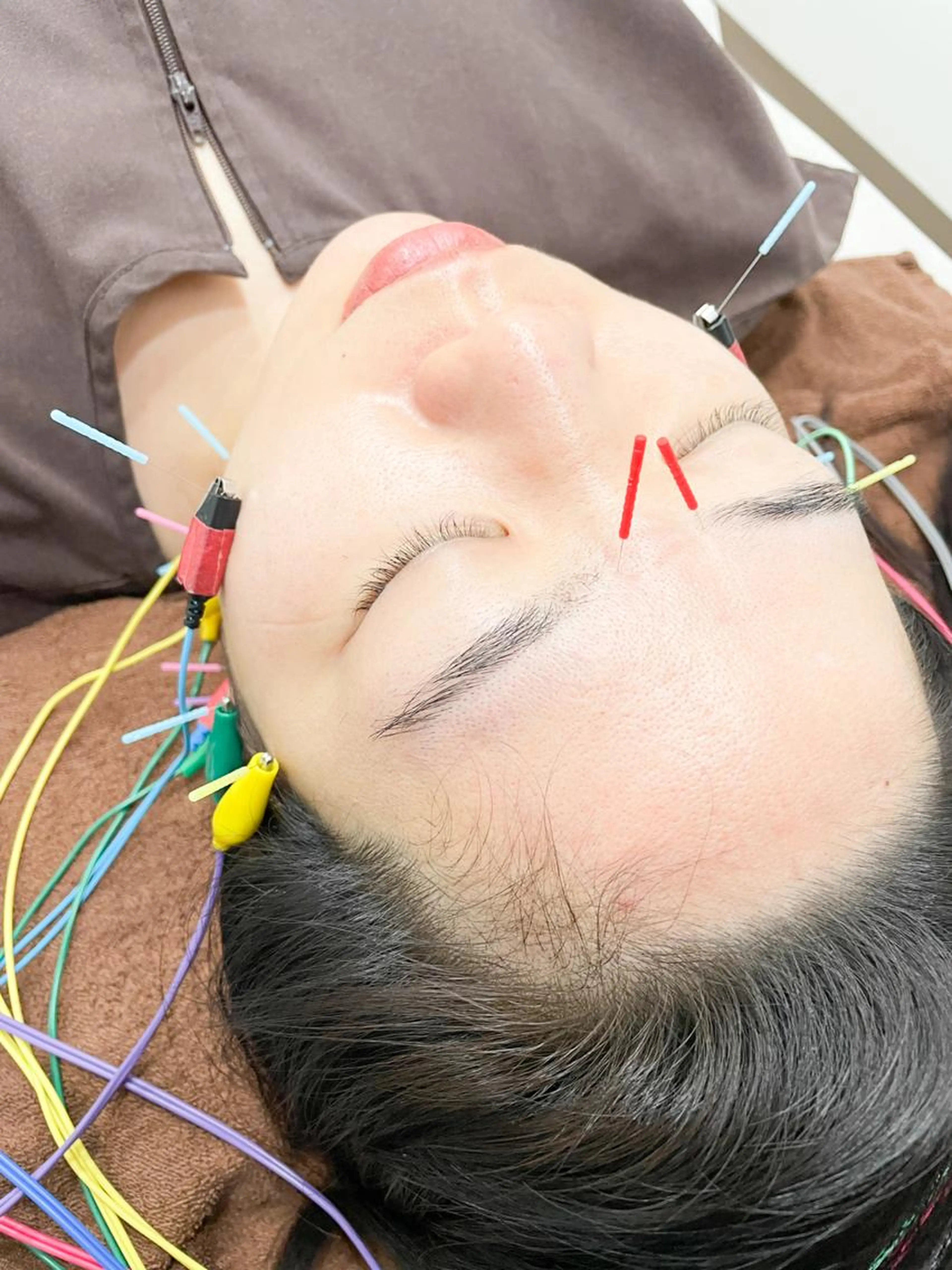 【たるみケア】美容鍼60分⭐️全身鍼+フェイシャルマッサージ＋保湿の写真