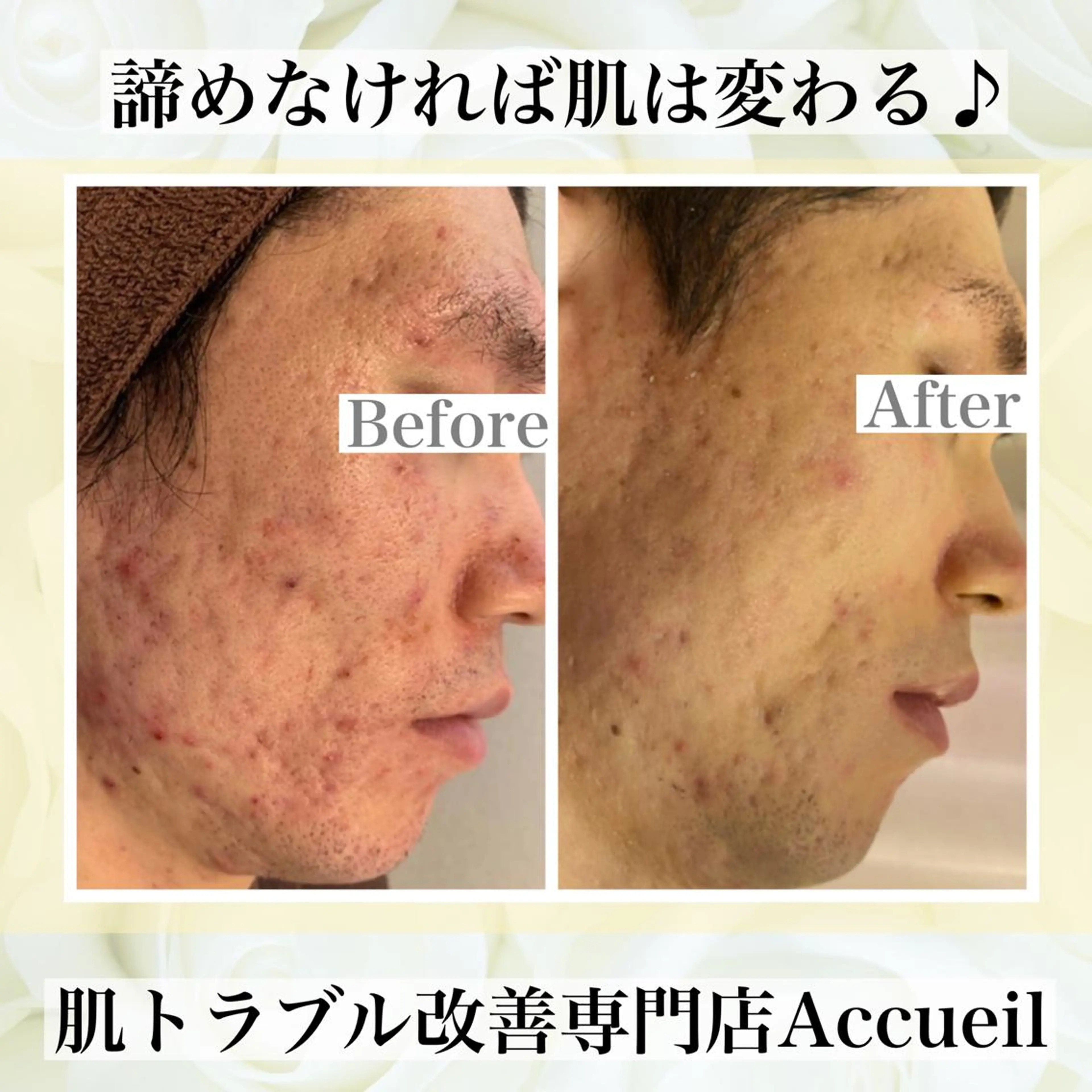 皮膚科より効果あり ⁉️最短ニキビ改善のエステ・リラクイメージ