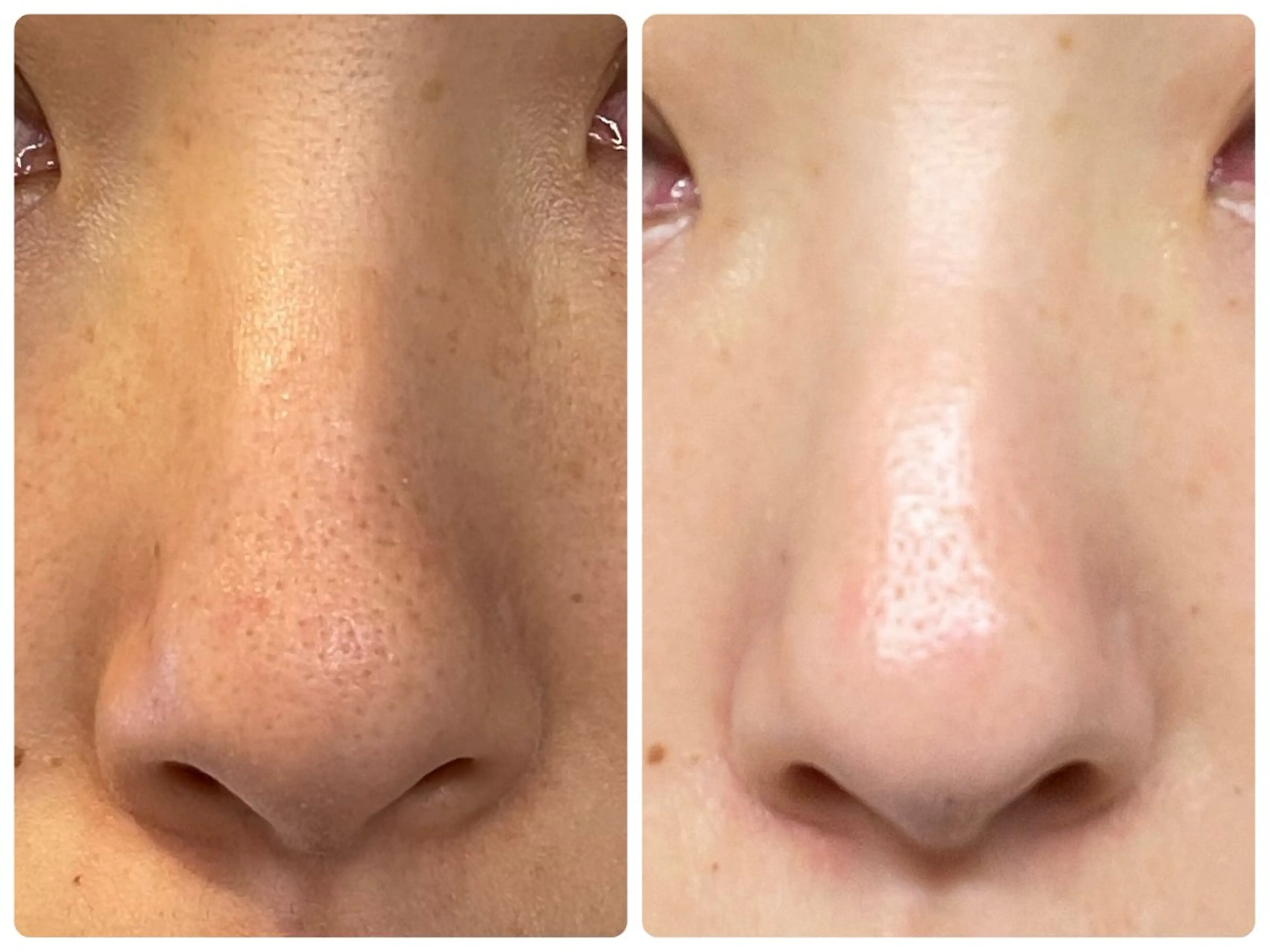 【鼻の毛穴👃症例写真モニター募集🙏】毛穴が気になる方・痛くない・即メイクOK・漢方生ハーブピーリング🌿の写真