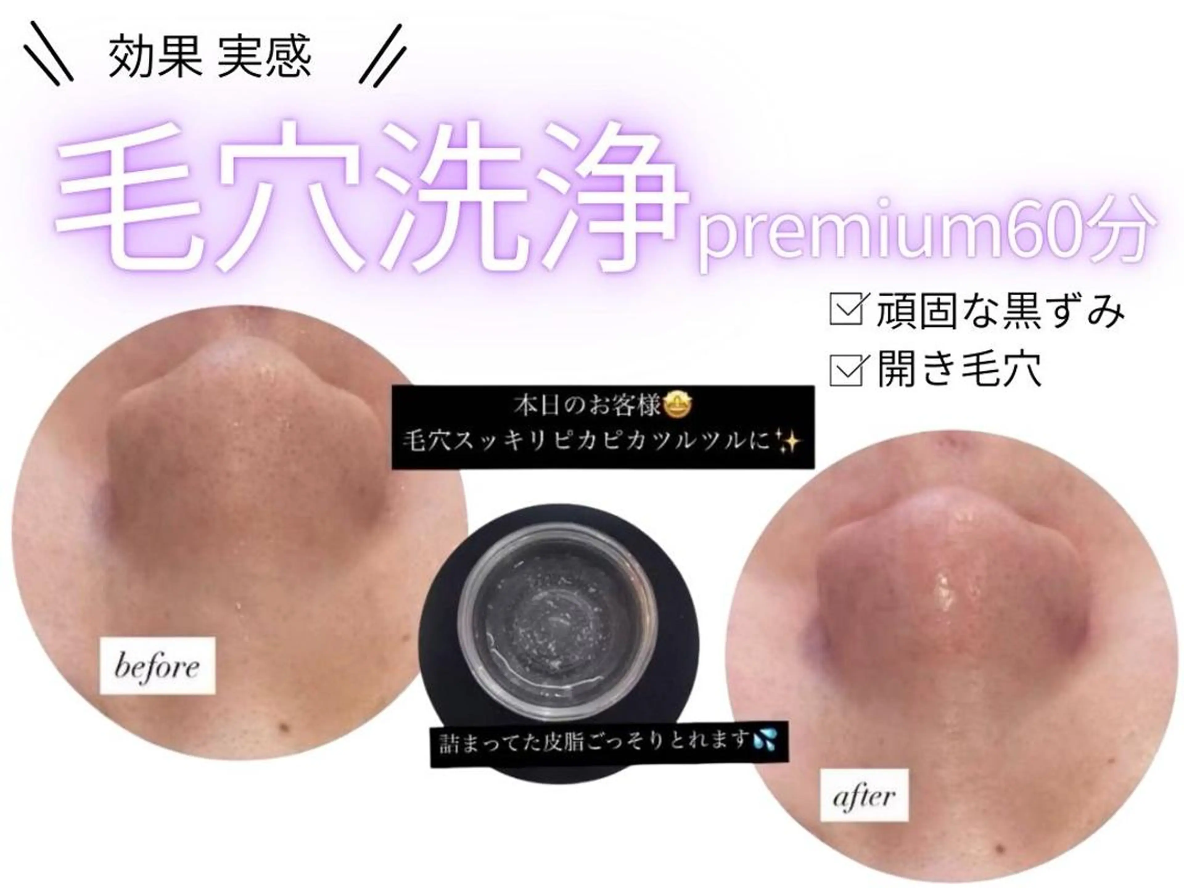 ✨9月限定✨＼夏の肌ダメージを速攻ケア!!／毛穴洗浄プレミアム60分の写真
