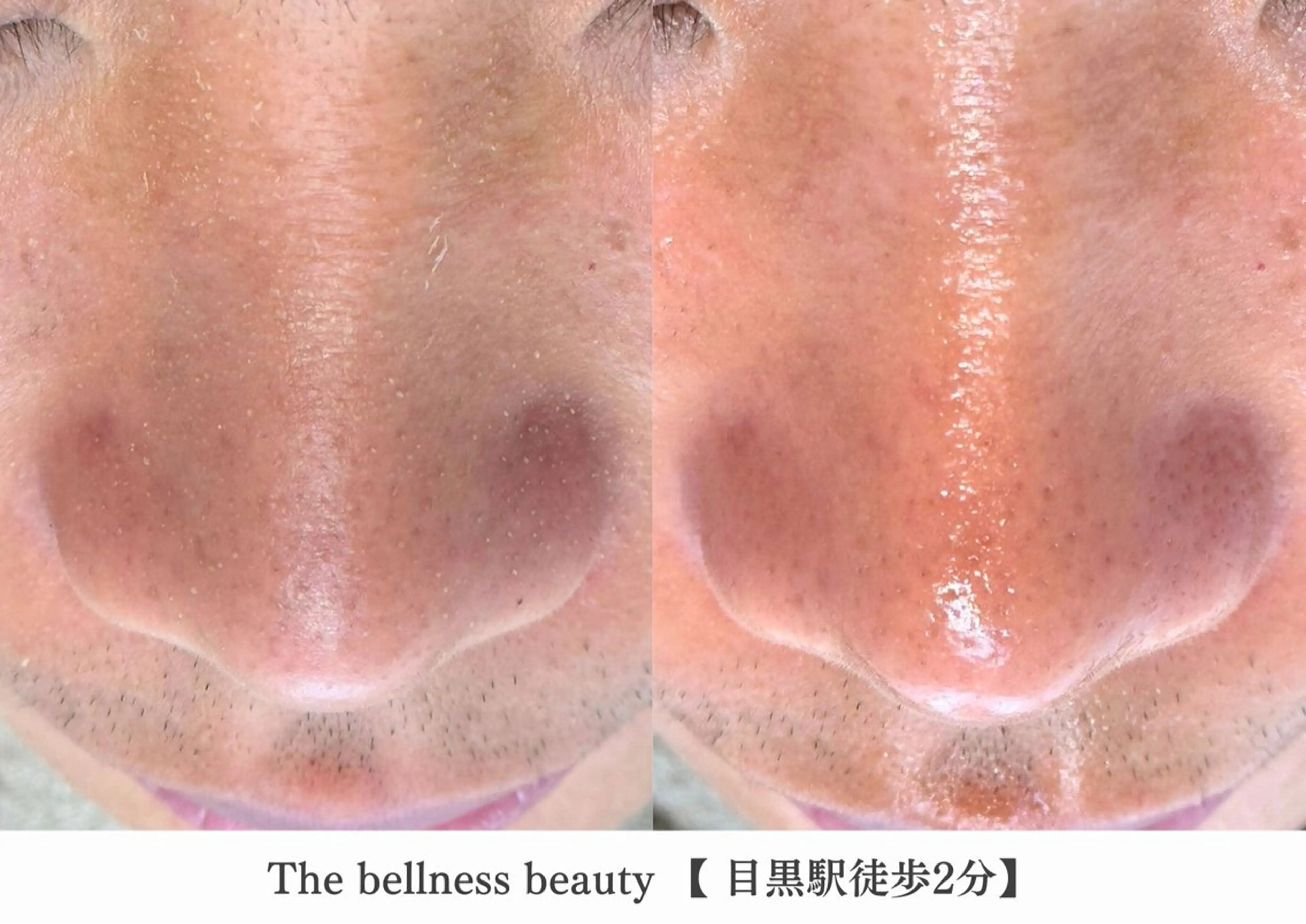 エステ 《毛穴レス美肌》ザ・ ベルネス 目黒駅2分のエステ・リラクイメージ