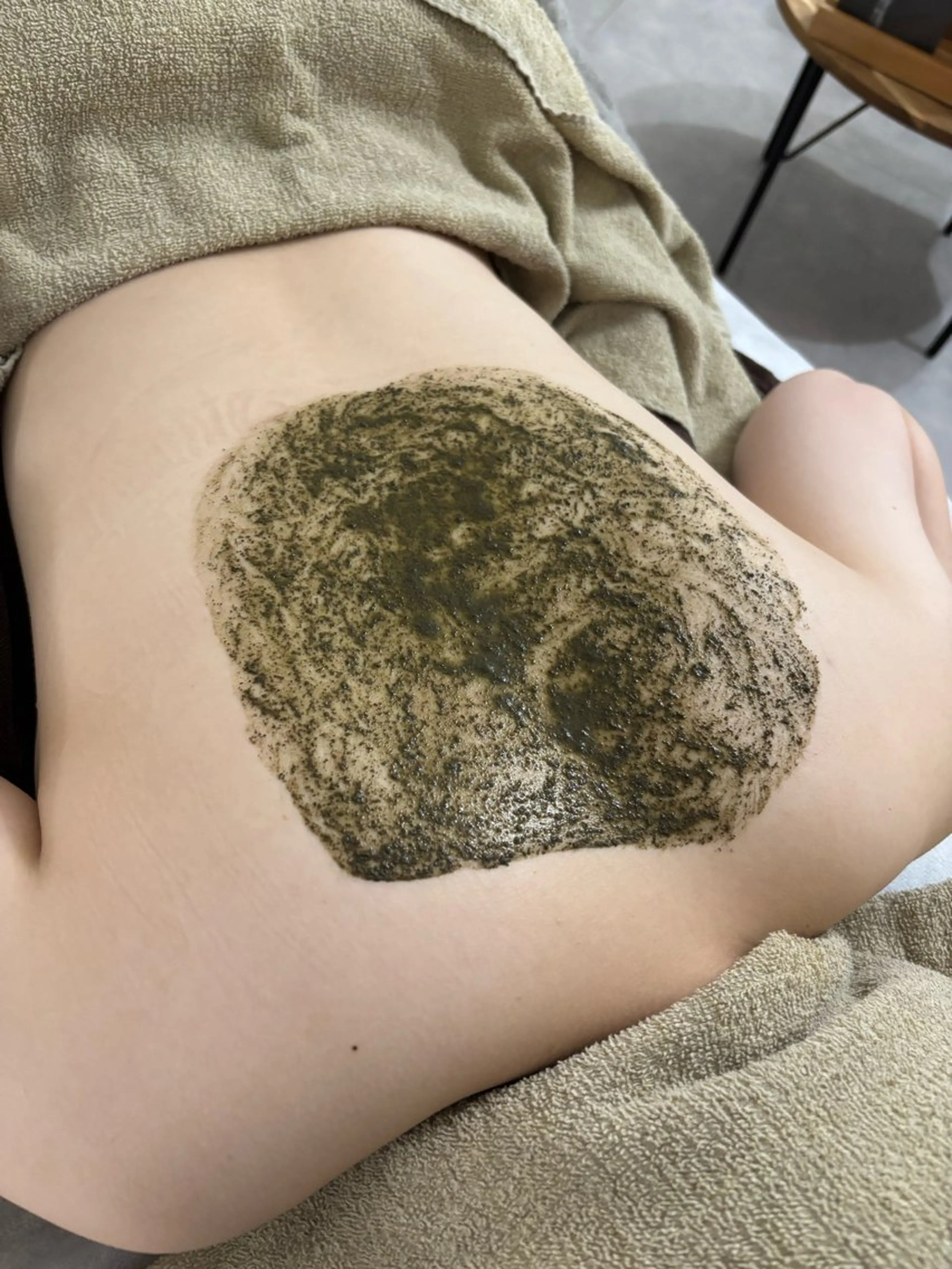 【平日限定⭐️ニキビケアでお悩みの方のみ】背中 REVIハーブピーリング （中心）の写真