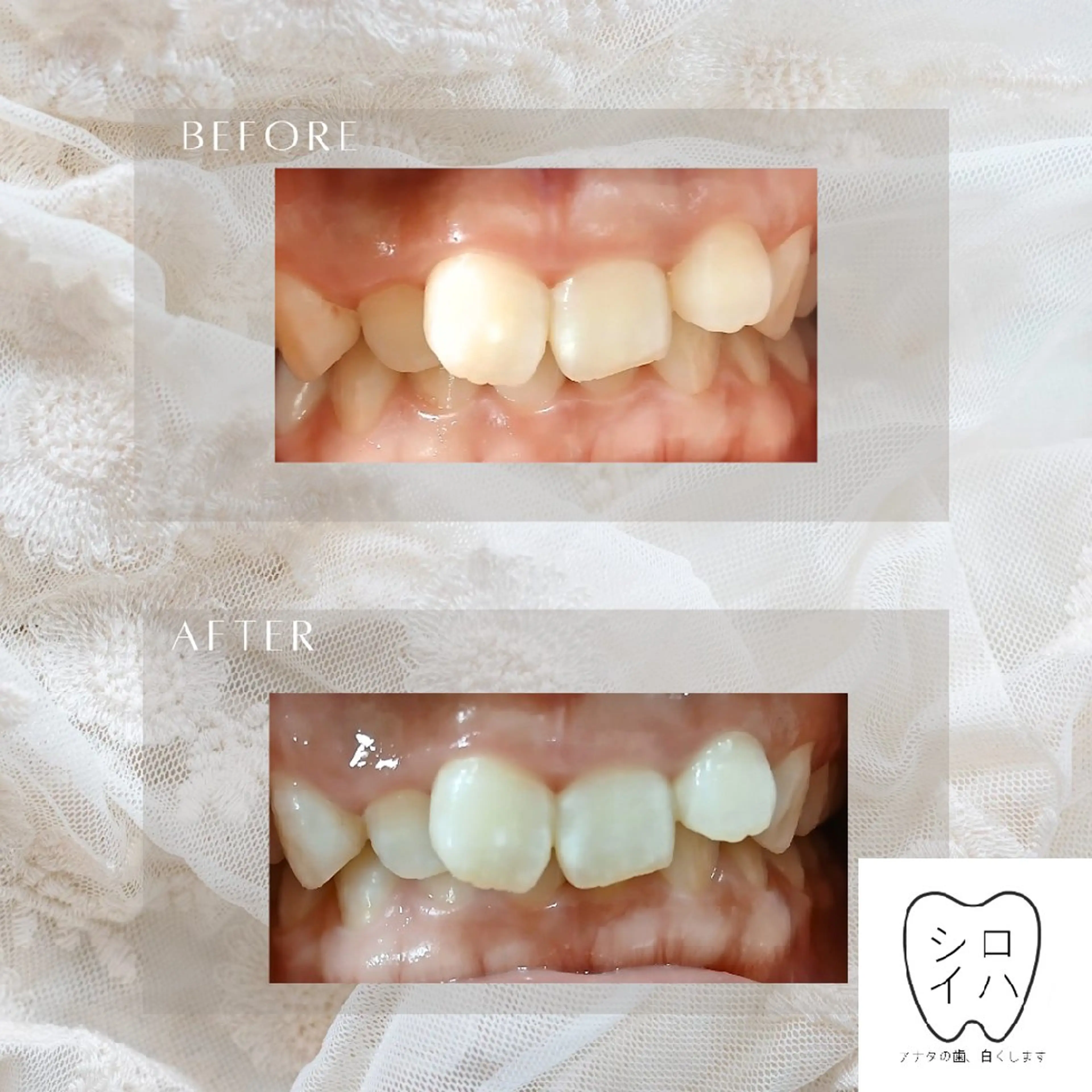 ホワイトニングサロン シロイハ所属・歯を白くしたい方🦷 シロイハのその他イメージ