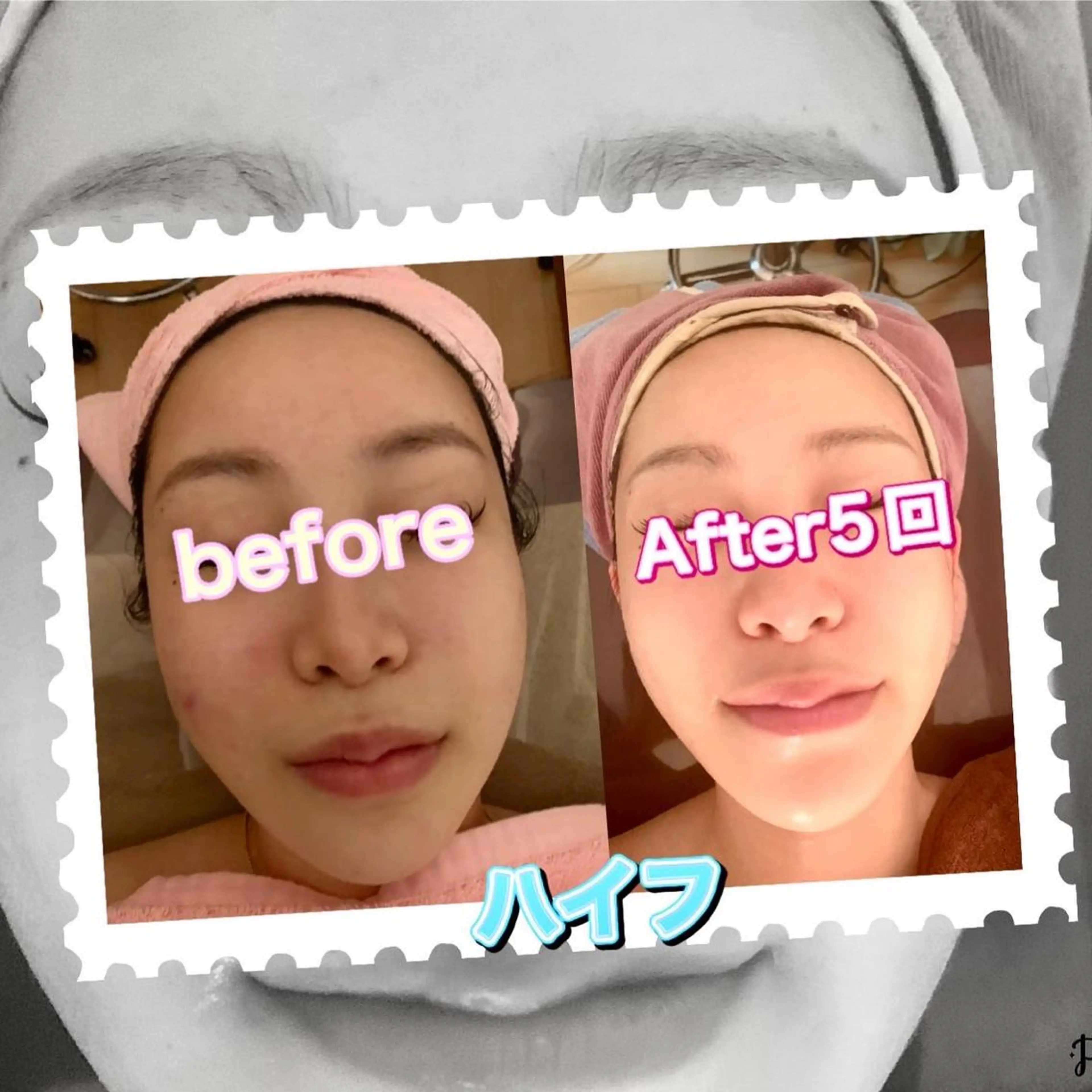 その他 【ハイパーナイフ痩身&小顔コルギ&ハーブピーリング】K-Beauty　東新宿所属・kーbeauty小顔 コルギ&インディバのエステ・リラクイメージ