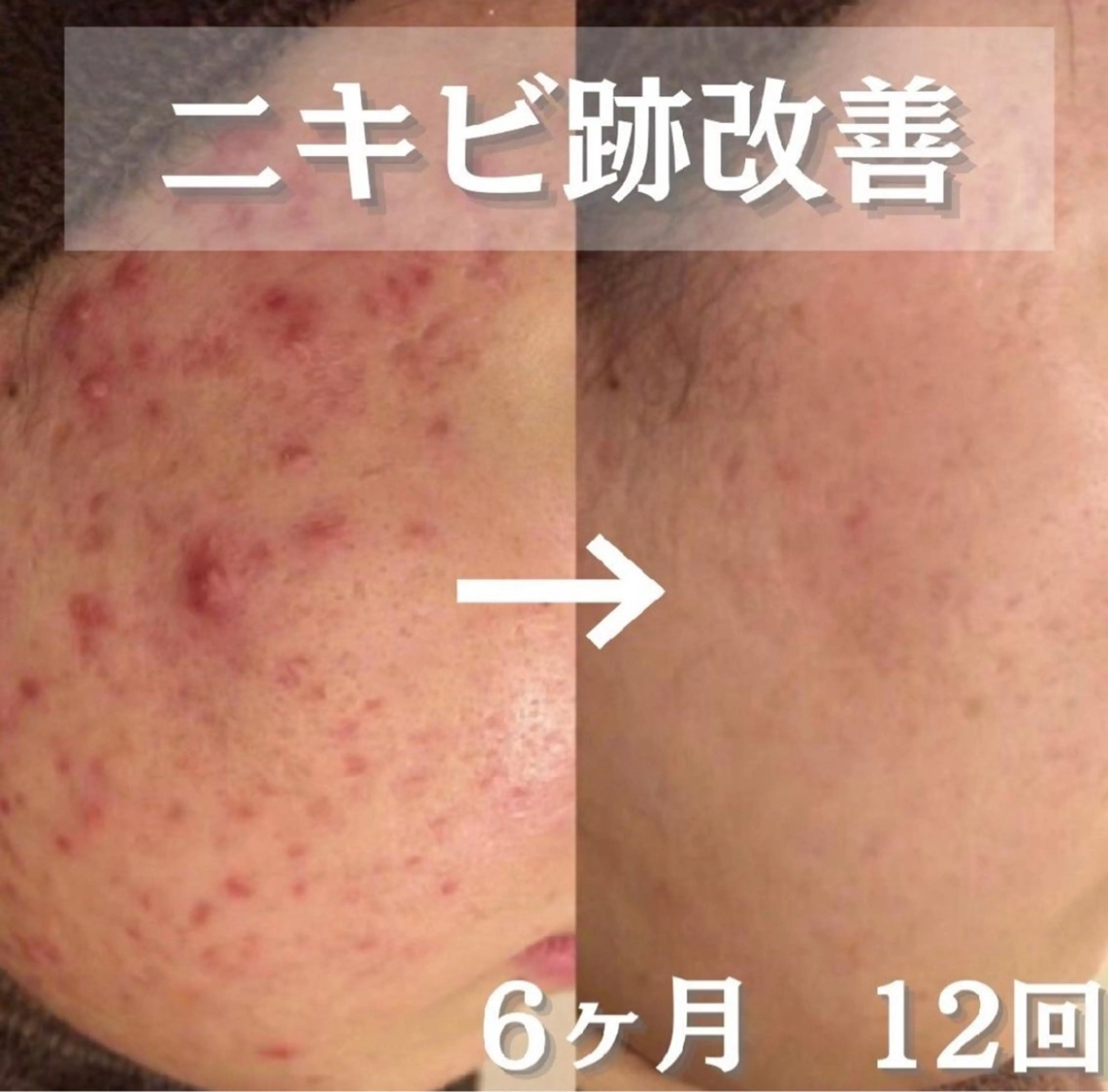 学生ニキビ改善🍀 優しい肌質改善のエステ・リラクイメージ