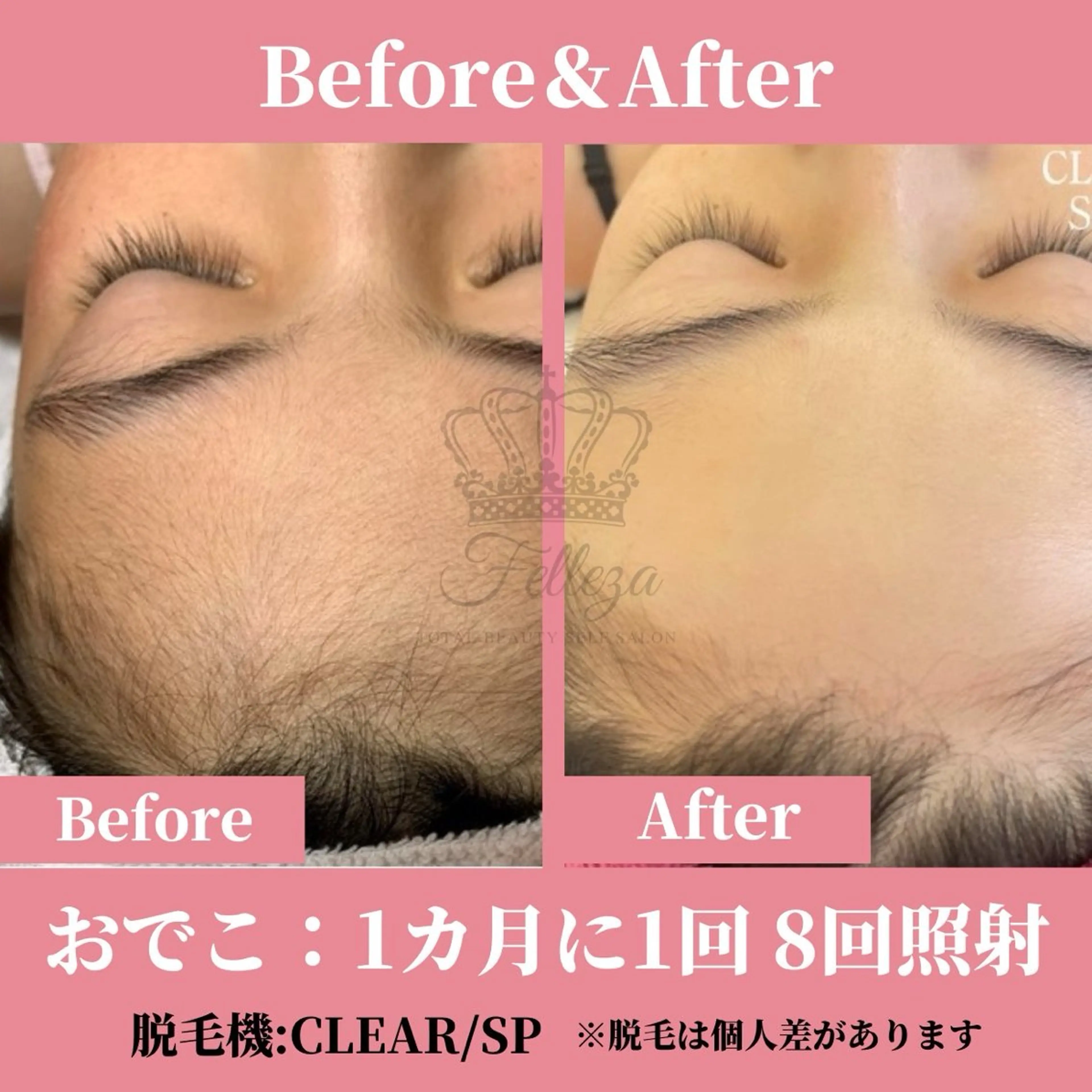 メンズ キッズ 有人型セルフサロン 脱毛/痩身/美顔のその他イメージ