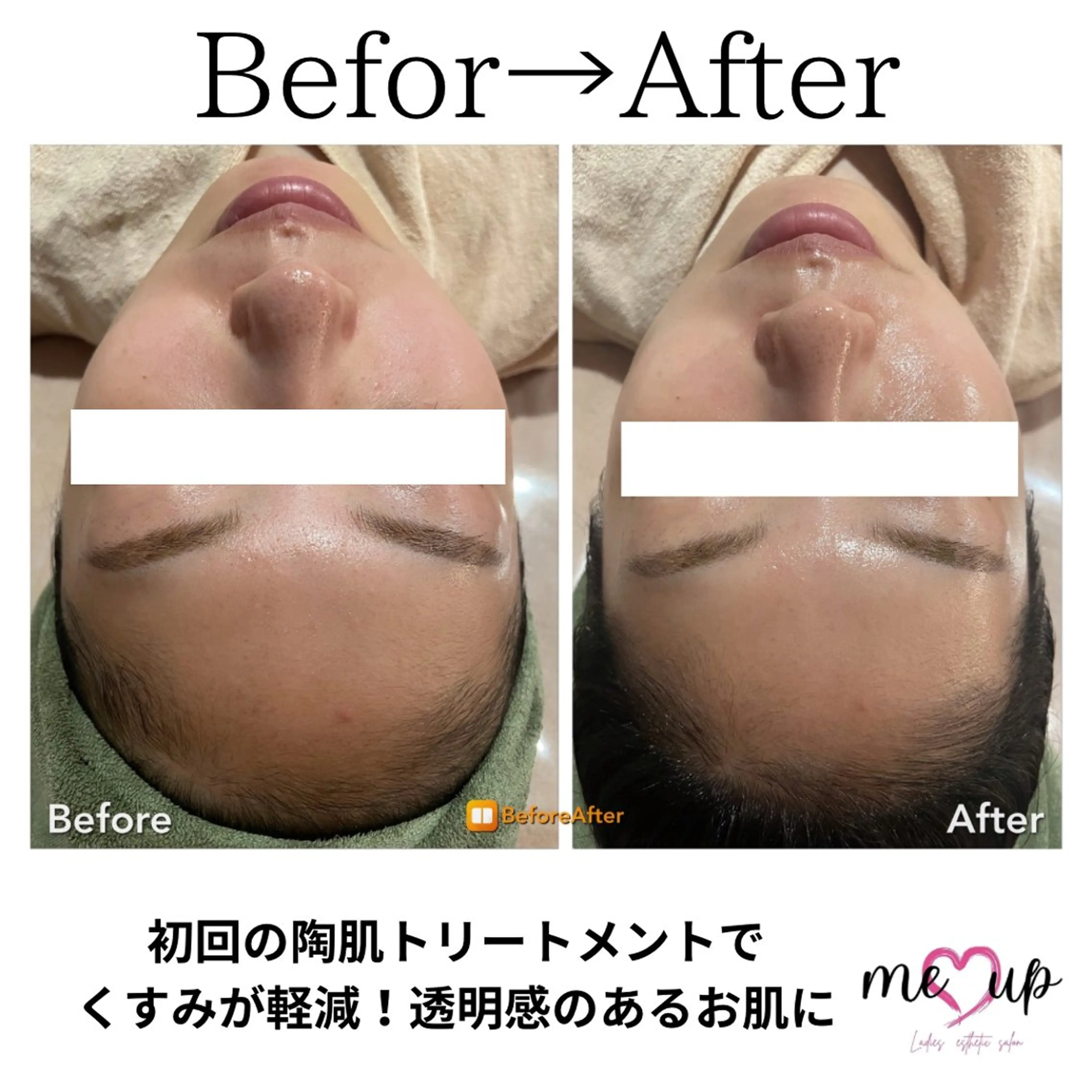 エステ Meupニキビ専門店 背中/ハーブ/ララのその他イメージ