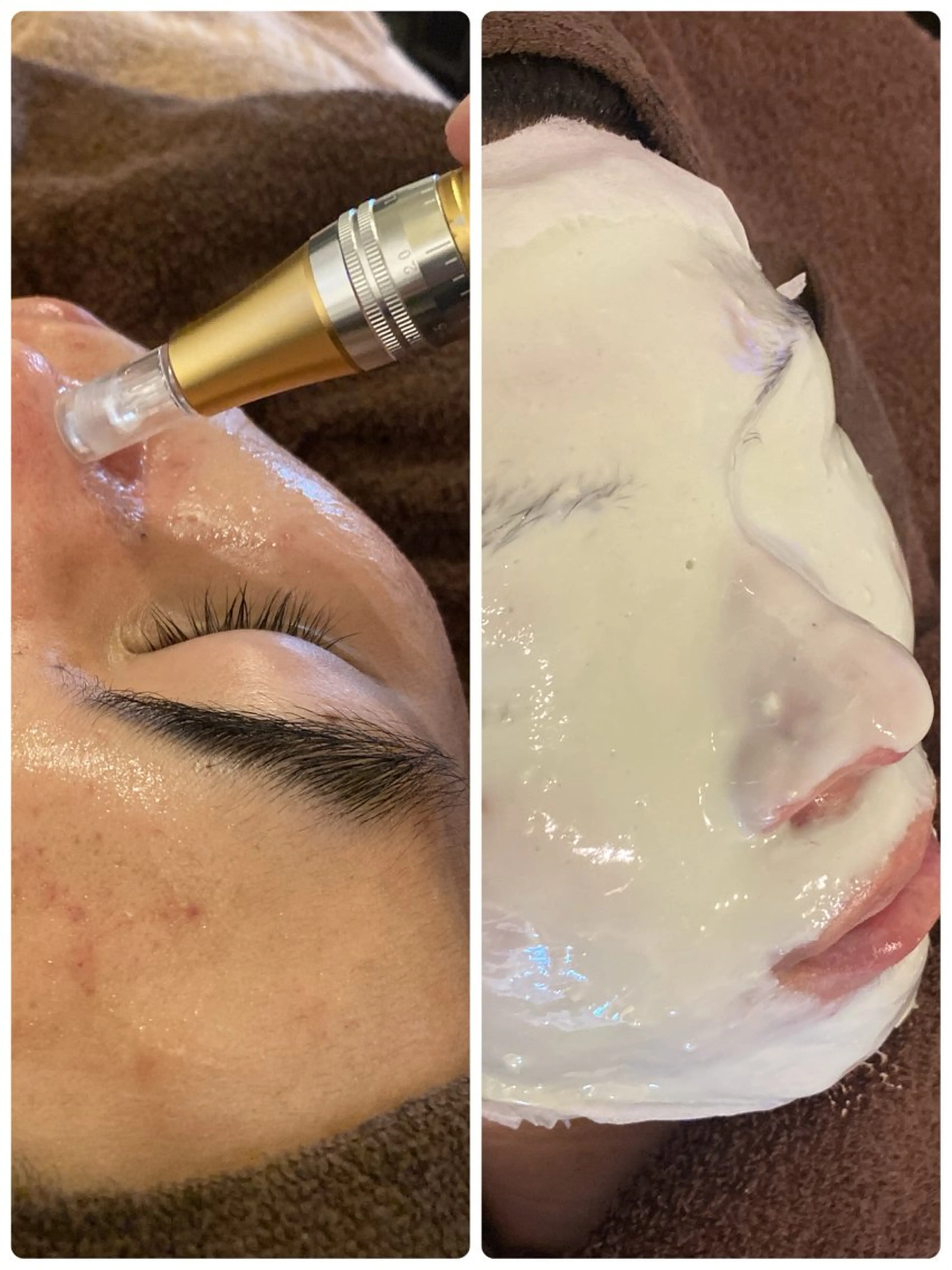 【毛穴の開き改善】毛穴洗浄ハイドラ＋毛穴収縮 15,000円→8,800円の写真