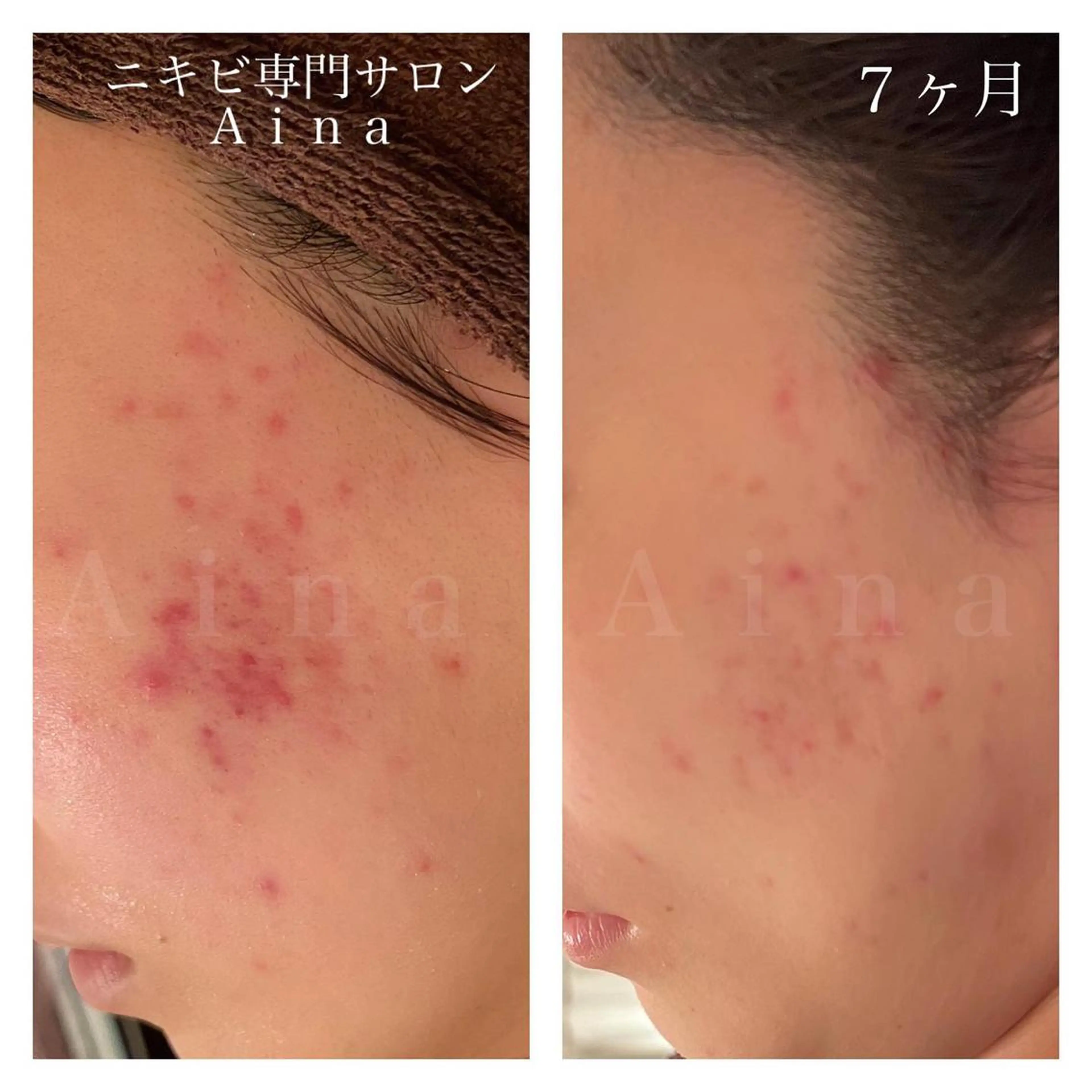 ロング カラー パーマ ヘアアレンジ メンズ キッズ ネイル マツエク・マツパ アイブロウ 赤色 ニキビ跡専門サロン Ａｉｎａのエステ・リラクイメージ