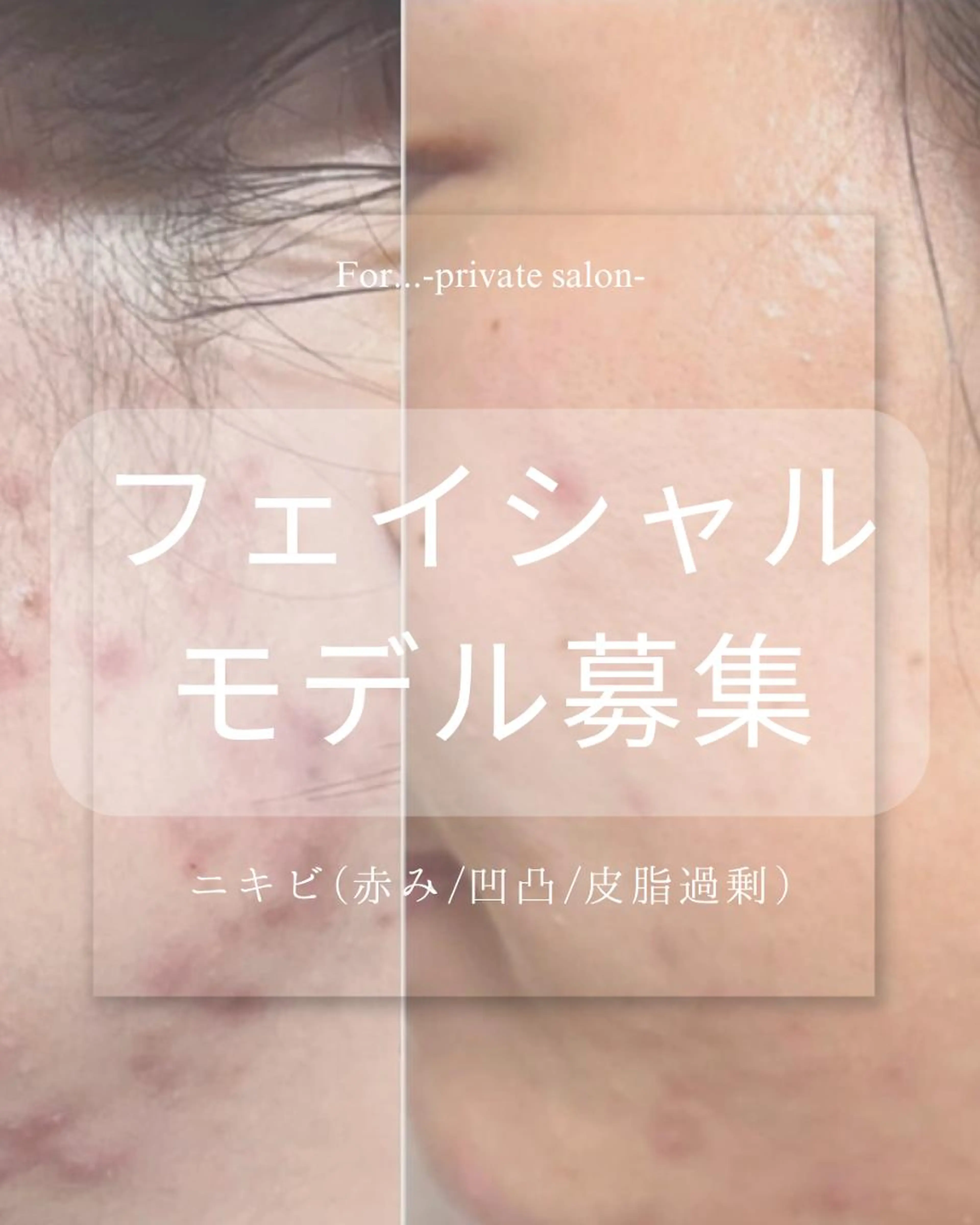 【モデル募集】ニキビ×赤みケア40分🫧長年の悩みに。(クレンジング→悩み別クリスティーナピーリング→マスク→仕上げ)の写真