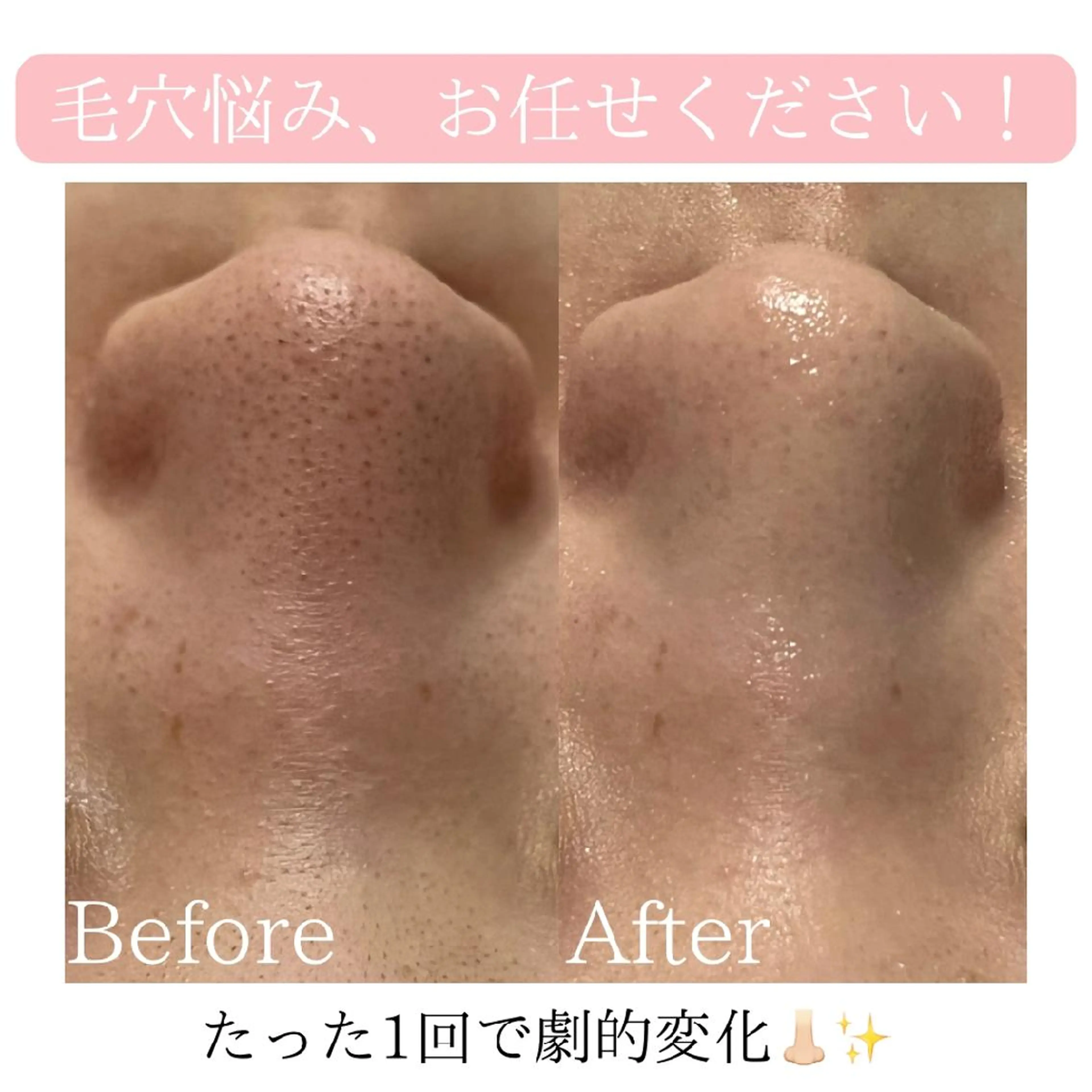 毛穴洗浄コース👃🏻✨イチゴ鼻とはサヨナラ！黒ずみ毛穴/つまり毛穴/開き毛穴でお悩みの方に！の写真