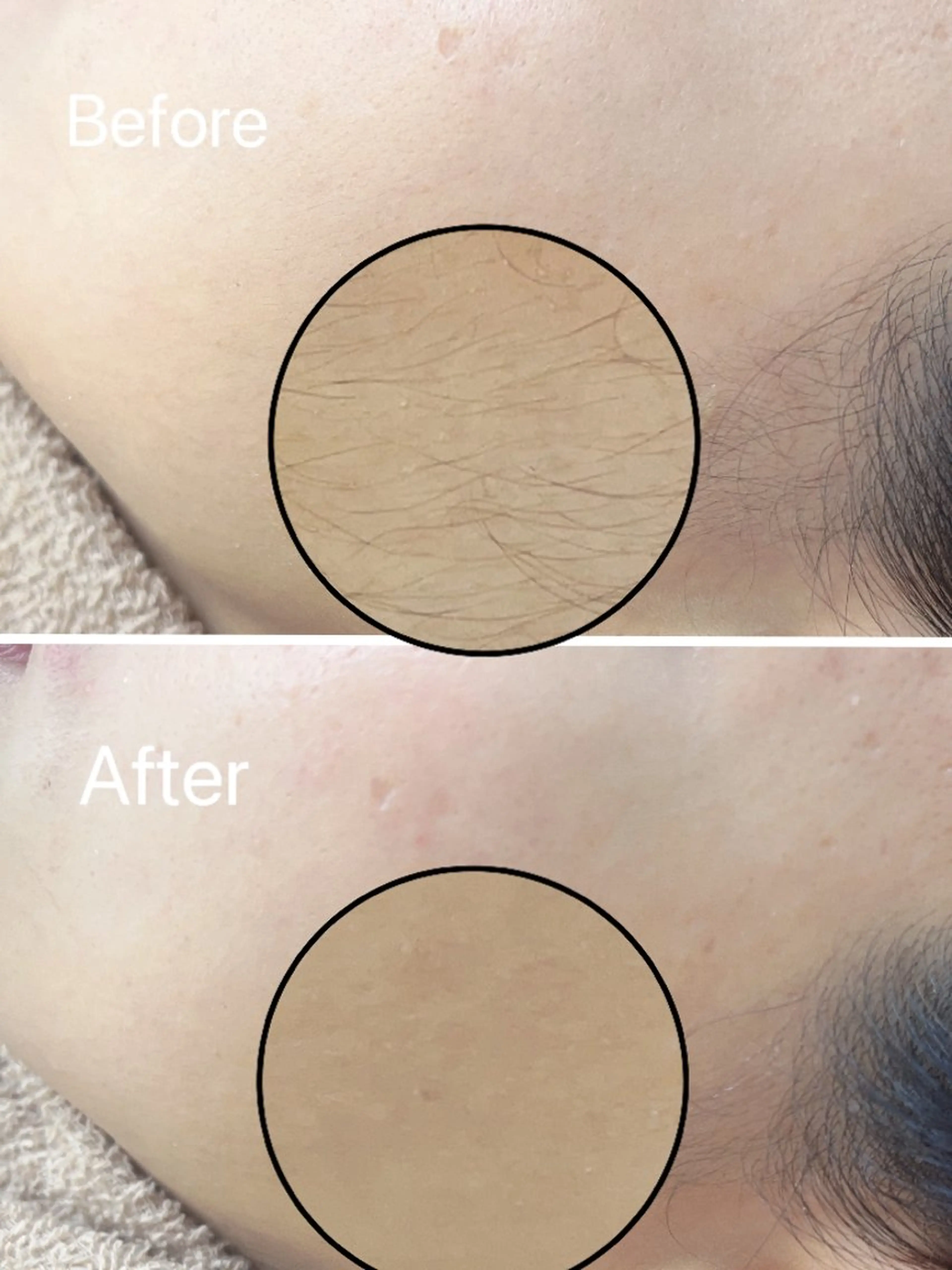 フルフェイスワックス脱毛(パックつき)の写真