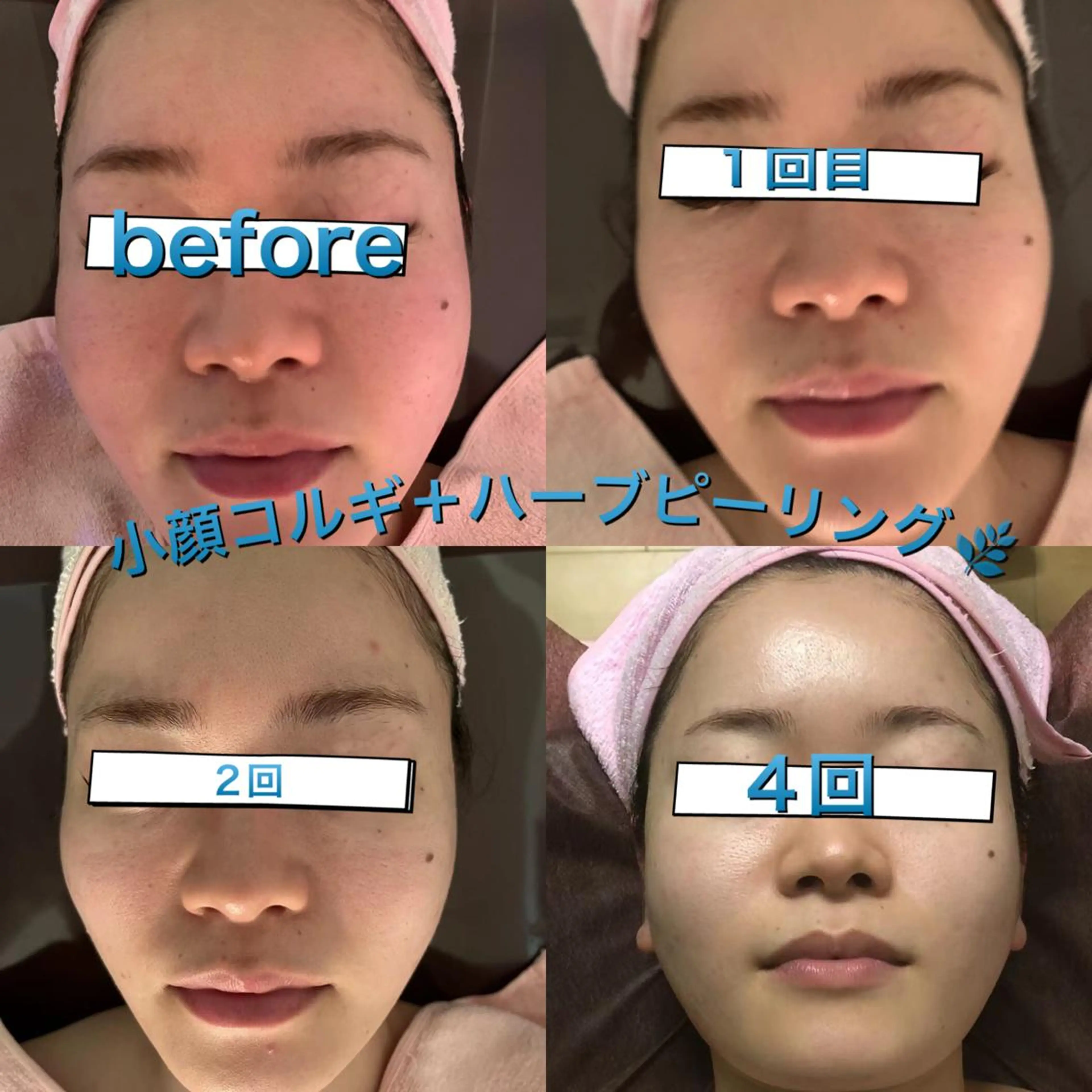 【ハイパーナイフ痩身&小顔コルギ&ハーブピーリング】K-Beauty　東新宿所属・kーbeauty小顔 コルギ&インディバのエステ・リラクイメージ